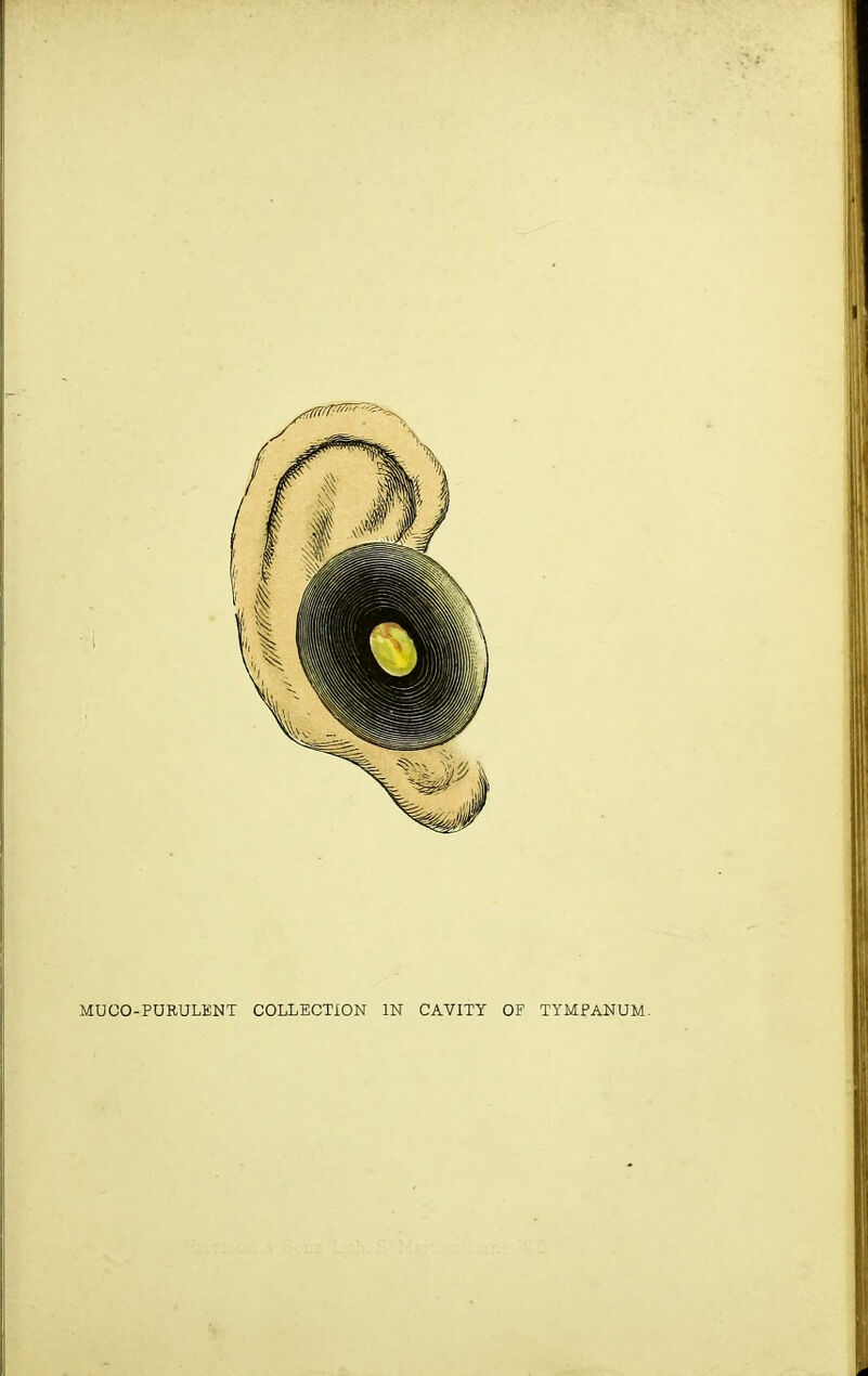 MUCO-PURULENT COLLECTION IN CAVITY OF TYMPANUM.