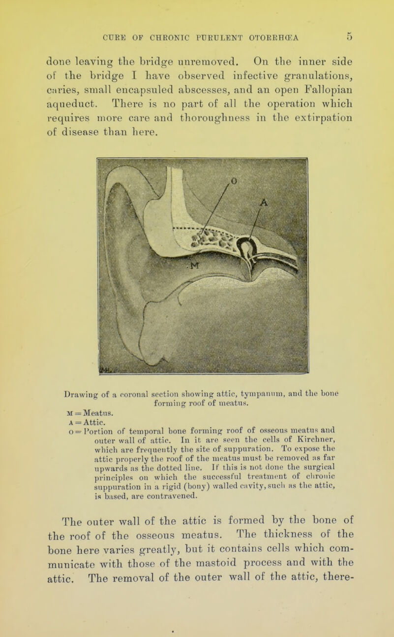 done leaving the bridge unreraoved. On the inner side of the bridge I have observed infective granulations, caries, small encapsuled abscesses, and an open Fallopian aqueduct. There is no part of all the operation which requires more care and thoroughness in the extirpation of disease than here. Drawing of a ooronal section showing attic, tynipaiunn, ami the hone forming roof of nieatns. M = Meatus. A = Attic. o= Portion of temporal bone forming roof of osseous meatns and outer wall of attic. In it are seen the cells of Kirchner, which are frequently tlie site of suppuration. To expose the attic properly tiie roof of the meatus must be removed iis far upwards as the dotted line. If this is not done the surgical principles on wliich the successful treatment of clironic suppuration in a rigid (bony) wailed c:ivity,such as the attic, is based, are contravened. The outer wall of the attic is formed by the bone of the roof of the osseous meatus. The thickness of the bone here varies greatly, but it contains cells which com- municate with those of the mastoid process and with the attic. The removal of the outer wall of the attic, there-