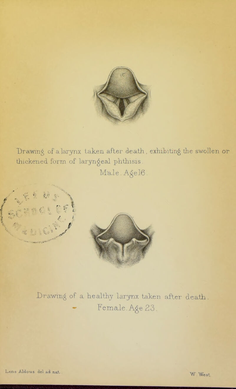 Drawing of ala]3/nx taken after death , exlutitin^ the swollen or Urnckened form of laryngeal plitl'iisis. M'ale. Agel6. Drawing of a healthy larynx talven after deatii. Femgile.AgeSS. Lens Aldous del a,<3 na!(^ W West