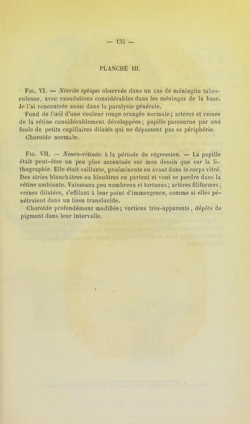 PLANCHE 111. FiG. YI. — Névrite optique observée dans un cas de méningite tuber- culeuse, avec exsudations considérables dans les méninges de la base. Je l'ai rencontrée aussi dans la paralysie générale. Fond de l'œil d'une couleur rouge orangée normale; artères et veines de la rétine considérablement développées ; papille parcourue par une foule de petits capillaires dilatés qui ne dépassent pas sa périphérie. Choroïde normale. FiG. VU. — Neuro-rétinite à la période de régression. — La papille était peut-être un peu plus accentuée sur mon dessin que sur la li- thographie. Elle était saillante, proéminente en avant dans le corps vitré. Des stries blanchâtres ou bleuâtres en partent et vont se perdre dans la rétine ambiante. Vaisseaux peu nombreux et tortueux; artères filiformes ; veines dilatées, s'effilant à leur point d'immergence, comme si elles pé- nétraient dans un tissu translucide. Choroïde profondément modifiée; vorlices très-apparents, dépôts de pigment dans leur intervalle.