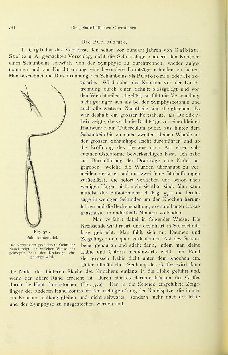 Die Pub ioto m i e. L. Gig Ii hat das Verdienst, den schon vor hundert Jahren von Galbiati, Stoltz u.A. gemachten Vorschlag, nicht die Schoossfuge, sondern den Knochen eines Schambeins seitwärts von der Symphyse zu durchtrennen, wieder aufge- nommen und zur Durchtrennung eine besondere Drahtsäge erfunden zu haben. Man bezeichnet die Durchtrennung des Schambeins als Pubiotomie oderHebo- tomie. Wird dabei der Knochen vor der Durch- trennung durch einen Schnitt blossgelegt und von den Weichtheilen abgelöst, so fällt die Verwundung nicht geringer aus als bei der Symphyseotomie und auch alle weiteren Nachtheile sind die gleichen. Es war deshalb ein grosser Fortschritt, als Doeder- 1 e i n zeigte, dass sich die Drahtsäge von einer kleinen Hautwunde am Tuberculum pubic. aus hinter dem Schambein bis zu einer zweiten kleinen Wunde an der grossen Schamlippe leicht durchführen und so die Eröffnung des Beckens nach Art einer sub- cutanen Osteotomie bewerkstelligen lässt. Ich habe zur Durchführung der Drahtsäge eine Nadel an- gegeben, welche die Wunden überhaupt zu ver- meiden gestattet und nur zwei feine Stichöffnungen zurücklässt, die sofort verkleben und schon nach wenigen Tagen nicht mehr sichtbar sind. Man kann mittelst der Pubiotomienadel (Fig. 571) die Draht- säge in wenigen Sekunden um den Knochen herum- führen und die Beckenspaltung, eventuell unter Lokal- anästhesie, in anderthalb Minuten vollenden. Man verfährt dabei in folgender Weise: Die Kreissende wird rasirt und desinfizirt in Steinschnitt- lage gebracht. Man fühlt sich mit Daumen und Zeigefinger den quer verlaufenden Ast des Scham- beins genau an und sticht dann, indem man kleine Labie und Clitoris medianwärts zieht, am Rand der grossen Labie dicht unter dem Knochen ein. Unter allmählicher Senkung des Griffes wird dann die Nadel der hinteren Fläche des Knochens entlang in die Höhe geführt und, wenn der obere Rand erreicht ist, durch starkes Herunterdrücken des Griffes durch die Haut durchstochen (Fig. 572). Der in die Scheide eingeführte Zeige- finger der anderen Hand kontrollirt den richtigen Gang der Nadelspitze, die immer am Knochen entlang gleiten und nicht seitwärts , sondern mehr nach der Mitte und der Symphyse zu ausgestochen werden soll. Fig- 57i- Pubiotomienadel. Das vergrössert gezeichnete Oehr der Nadel zeigt, in welcher Weise das geknöpfte Ende der Drahtsäge ein- gehängt wird.