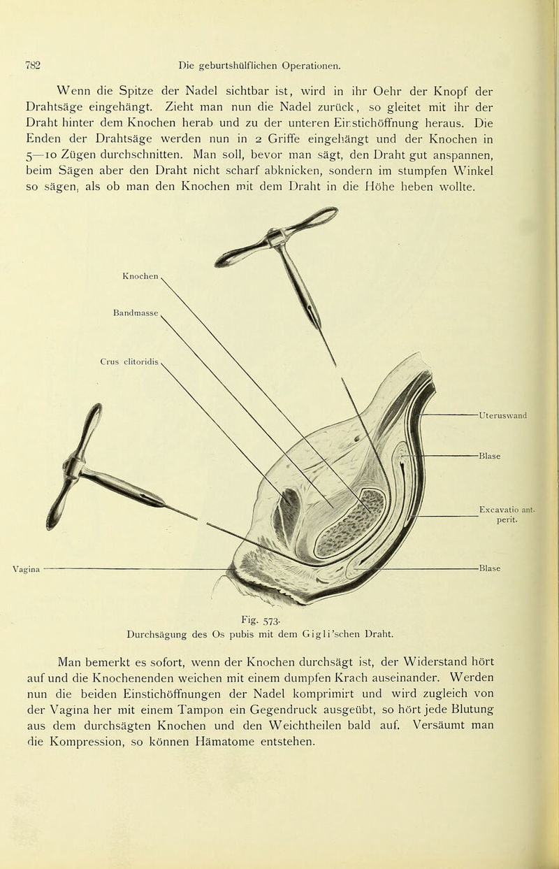 Wenn die Spitze der Nadel sichtbar ist, wird in ihr Oehr der Knopf der Drahtsäge eingehängt. Zieht man nun die Nadel zurück, so gleitet mit ihr der Draht hinter dem Knochen herab und zu der unteren Eir.stichöffnung heraus. Die Enden der Drahtsäge werden nun in 2 Griffe eingehängt und der Knochen in 5—10 Zügen durchschnitten. Man soll, bevor man sägt, den Draht gut anspannen, beim Sägen aber den Draht nicht scharf abknicken, sondern im stumpfen Winkel so sägen, als ob man den Knochen mit dem Draht in die Höhe heben wollte. Uteruswand ■Blase Excavatio ant. perit. •Blase Fig. 573- Durchsägung des Os pubis mit dem Gig Ii'sehen Draht. Man bemerkt es sofort, wenn der Knochen durchsägt ist, der Widerstand hört auf und die Knochenenden weichen mit einem dumpfen Krach auseinander. Werden nun die beiden Einstichöffnungen der Nadel komprimirt und wird zugleich von der Vagina her mit einem Tampon ein Gegendruck ausgeübt, so hört jede Blutung aus dem durchsägten Knochen und den Weichtheilen bald auf. Versäumt man die Kompression, so können Hämatome entstehen.