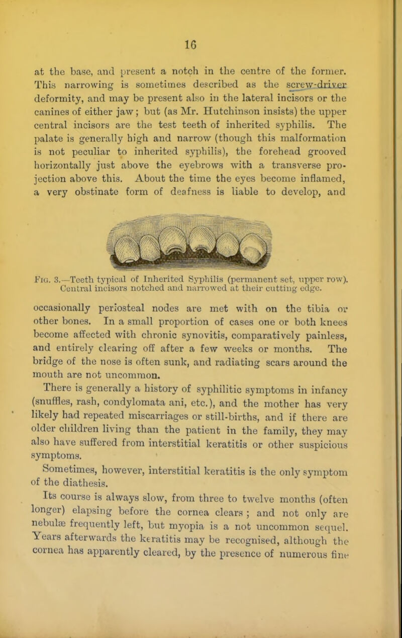 at the base, and present a notch in the centre of the former. This narrowing is sometimes described as the 8crew.-dri.Yjer deformity, and may be present also in the lateral incisors or the canines of either jaw; but (as Mr. Hutchinson insists) the upper central incisors are the test teeth of inherited syphilis. The palate is generally high and narrow (though this malformation is not peculiar to inherited syphilis), the forehead grooved horizontally just above the eyebrows with a transverse pro- jection above this. About the time the eyes become inflamed, a very obstinate form of deafness is liable to develop, and Fig. 3.—Teeth typical of Inherited Syphilis (permanent set, upper row). Central incisors notched and narrowed at their cutting edge. occasionally periosteal nodes are met with on the tibia or other bones. In a small proportion of cases one or both knees become affected with chronic synovitis, comparatively painless, and entirely clearing off after a few weeks or months. The bridge of the nose is often sunk, and radiating scars around the mouth are not uncommon. There is generally a history of syphilitic symptoms in infancy (snuffles, rash, condylomata ani, etc.), and the mother has very likely had repeated miscarriages or still-births, and if there are older children living than the patient in the family, they may also have suffered from interstitial keratitis or other suspicious symptoms. Sometimes, however, interstitial keratitis is the only symptom of the diathesis. Its course is always slow, from three to twelve months (often longer) elapsing before the cornea clears ; and not only are nebulas frequently left, but myopia is a not uncommon sequel. Years afterwards the keratitis may be recognised, although the cornea has apparently cleared, by the presence of numerous fine