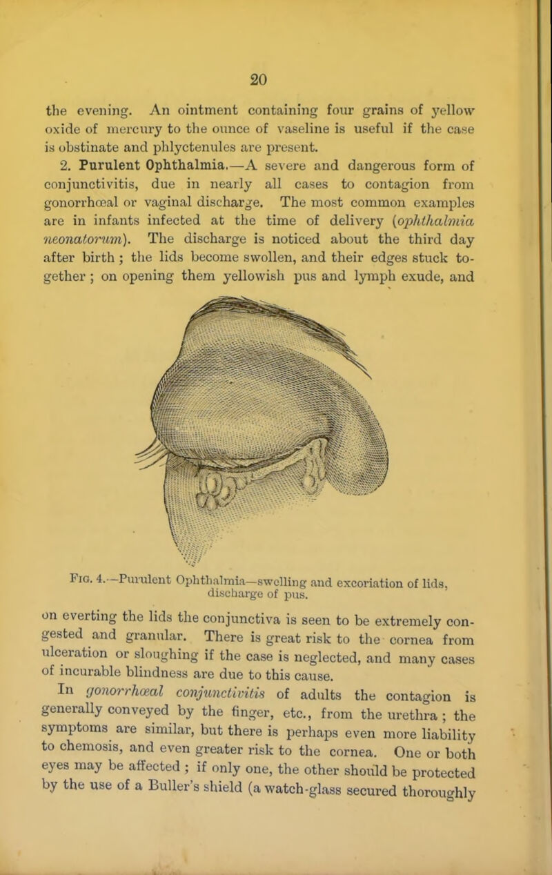 the evening. An ointment containing four grains of yellow oxide of mercury to the ounce of vaseline is useful if the case is obstinate and phlyctenules are present. 2. Purulent Ophthalmia—A severe and dangerous form of conjunctivitis, due in nearly all cases to contagion from gonorrhceal or vaginal discharge. The most common examples are in infants infected at the time of delivery (ophthalmia neonatorum). The discharge is noticed about the third day after birth ; the lids become swollen, and their edges stuck to- gether ; on opening them yellowish pus and lymph exude, and Fio. 4.—Purulent Ophthalmia—swelling and excoriation of lids, discharge of pus. on everting the lids the conjunctiva is seen to be extremely con- gested and granular. There is great risk to the cornea from ulceration or sloughing if the case is neglected, and many cases of incurable blindness are due to this cause. In gonorrhceal conjunctivitis of adults the contagion is generally conveyed by the finger, etc., from the urethra ; the symptoms are similar, but there is perhaps even more liability to chemosis, and even greater risk to the cornea. One or both eyes may be affected ; if only one, the other should be protected by the use of a Buller's shield (a watch-glass secured thoroughly