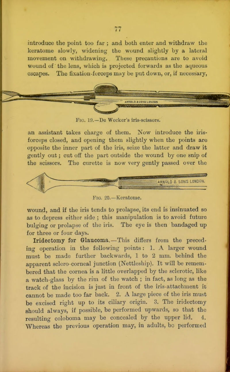 introduce the point too far ; and both enter and withdraw the keratome slowly, widening the wound slightly by a lateral movement on withdrawing. These precautions are to avoid wound of the lens, which is projected forwards as the aqueous escapes. The fixation-forceps may be put down, or, if necessary, Flu. 19.—De Wccker's iris-scissors. an assistant takes charge of them. Now introduce the iris- forceps closed, and opening them slightly when the points are opposite the inner part of the iris, seize the latter and draw it gently out; cut off the part outside the wound by one snip of the scissors. The curette is now very gently passed over the Fio. 20.—Keratome. wound, and if the iris tends to prolapse, its end is insinuated so as to depress either side ; this manipulation is to avoid future bulging or prolapse of the iris. The eye is then bandaged up for three or four days. Iridectomy for Glaucoma.—This differs from the preced- ing operation in the following points: LA larger wound must be made further backwards, 1 to 2 mm. behind the apparent sclero-corneal junction (Nettleship). It will be remem- bered that the cornea is a little overlapped by the sclerotic, like a watch-glass by the rim of the watch ; in fact, as long as the track of the incision is just in front of the iris-attachment it cannot be made too far back. 2. A large piece of the iris must be excised right up to its ciliary origin. 3. The iridectomy should always, if possible, be performed upwards, so that the resulting coloboma may be concealed by the upper lid. 4. Whereas the previous operation may, in adults, bo performed