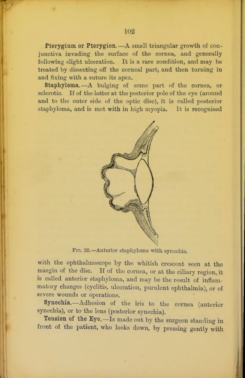 Pterygium or Pterygion,—A small triangular growth of con- junctiva invading the surface of the cornea, and generally following slight ulceration. It is a rare condition, and may be treated by dissecting off the corneal part, and then turning in and fixing with a suture its apex. Staphyloma.—A bulging of some part of the cornea, or sclerotic. If of the latter at the posterior pole of the eye (around and to the outer side of the optic disc), it is called posterior staphyloma, and is met with in high myopia. It is recognised Fie. 30.—Anterior staphyloma with synechia. with the ophthalmoscope by the whitish crescent seen at the margin of the disc. If of the cornea, or at the ciliary region, it is called anterior staphyloma, and may be the result of inflam- matory changes (cyclitis. ulceration, purulent ophthalmia), or of severe wounds or operations. Synechia.—Adhesion of the iris to the cornea (anterior synechia), or to the lens (posterior synechia). Tension of the Eye.—Is made out by the surgeon standing in front of the patient, who looks down, by pressing gently with