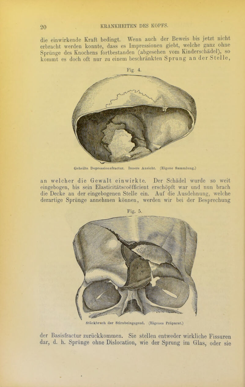 die einwirkende Kraft bedingt. Wenn auch der Beweis bis jetzt nicht erbracht werden konnte, dass es Impressionen giebt, welche ganz ohne Sprünge des Knochens fortbestanden (abgesehen vom Kinderschädel), so kommt es doch oft nur zu einem beschränkten Sprung an der Stelle, Fig. 4. Geheilte Depressionsfractur. Innere Ansicht. (Eigene Sammlung.) an welcher die Gewalt einwirkte. Der Schädel wurde so weit eingebogen, bis sein Elasticitätscoefficient erschöpft war und nun brach die Decke an der eingebogenen Stelle ein. Auf die Ausdehnung, welche derartige Sprünge annehmen können, werden wir bei der Besprechung Stiiekbriich der Stirnbeingegend. (Eigenes Präparat.) der Basisfractur zurückkommen. Sie stellen entweder wirkliche Fissuren dar, d. h. Sprünge ohne Dislocation, wie der Sprung im Glas, oder sie