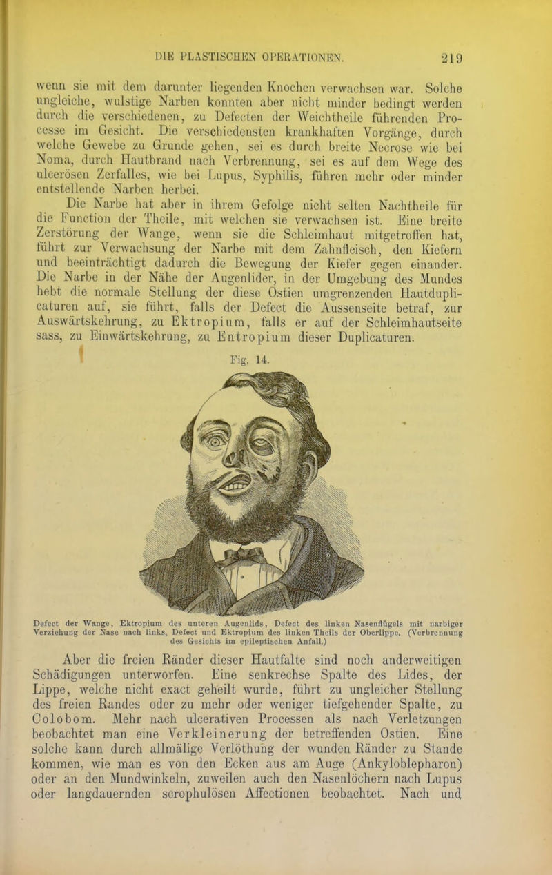 wenn sie mit dem darunter liegenden Knochen verwachsen war. Solche angleiche, wulstige Narben konnten aber nicht minder bedingt werden durch die verschiedenen, zu Defecten der Weichtheile führenden Pro- cesse im Gesicht. Die verschiedensten krankhaften Vorgänge, durch welche Gewebe zu Grunde gehen, sei es durch breite Necrose wie bei Noma, durch Hautbrand nach Verbrennung, sei es auf dem Wege des ulcerösen Zerfalles, wie bei Lupus, Syphilis, führen mehr oder minder entstellende Narben herbei. Die Narbe hat aber in ihrem Gefolge nicht selten Nachtheile für die Function der Theile, mit welchen sie verwachsen ist. Eine breite Zerstörung der Wange, wenn sie die Schleimhaut mitgetroüen hat, führt zur Verwachsung der Narbe mit dem Zahnfleisch, den Kiefern und beeinträchtigt dadurch die Bewegung der Kiefer gegen einander. Die Narbe in der Nähe der Augenlider, in der Umgebung des Mundes hebt die normale Stellung der diese Ostien umgrenzenden Hautdupli- caturen auf, sie führt, falls der Defect die Ä^ssenseite betraf, zur Auswärtskehrung, zu Ektropium, falls er auf der Schleimhautseite sass, zu Einwärtskehrung, zu Entropium dieser Duplicaturen. Fig. 14. Defect der Wange, Ektropium des unteren Augenlids, Defect des linken Nasenflügels mit narbiger Verzieliung der Nase nach links, Defect und Ektropium des linken Theils der Oberlippe. (Verbrennung des Gesichts im epileptischen Anfall.) Aber die freien Ränder dieser Hautfalte sind noch anderweitigen Schädigungen unterworfen. Eine senkrechse Spalte des Lides, der Lippe, welche nicht exaet geheilt wurde, führt zu ungleicher Stellung des freien Randes oder zu mehr oder weniger tiefgehender Spalte, zu Colobom. Mehr nach ulcerativen Processen als nach Verletzungen beobachtet man eine Verkleinerung der betreffenden Ostien. Eine solche kann durch allmälige Verlöthung der wunden Ränder zu Stande kommen, wie man es von den Ecken aus am Auge (Ankyloblepharon) oder an den Mundwinkeln, zuweilen auch den Nasenlöchern nach Lupus oder langdauernden scrophulösen Affectionen beobachtet. Nach und