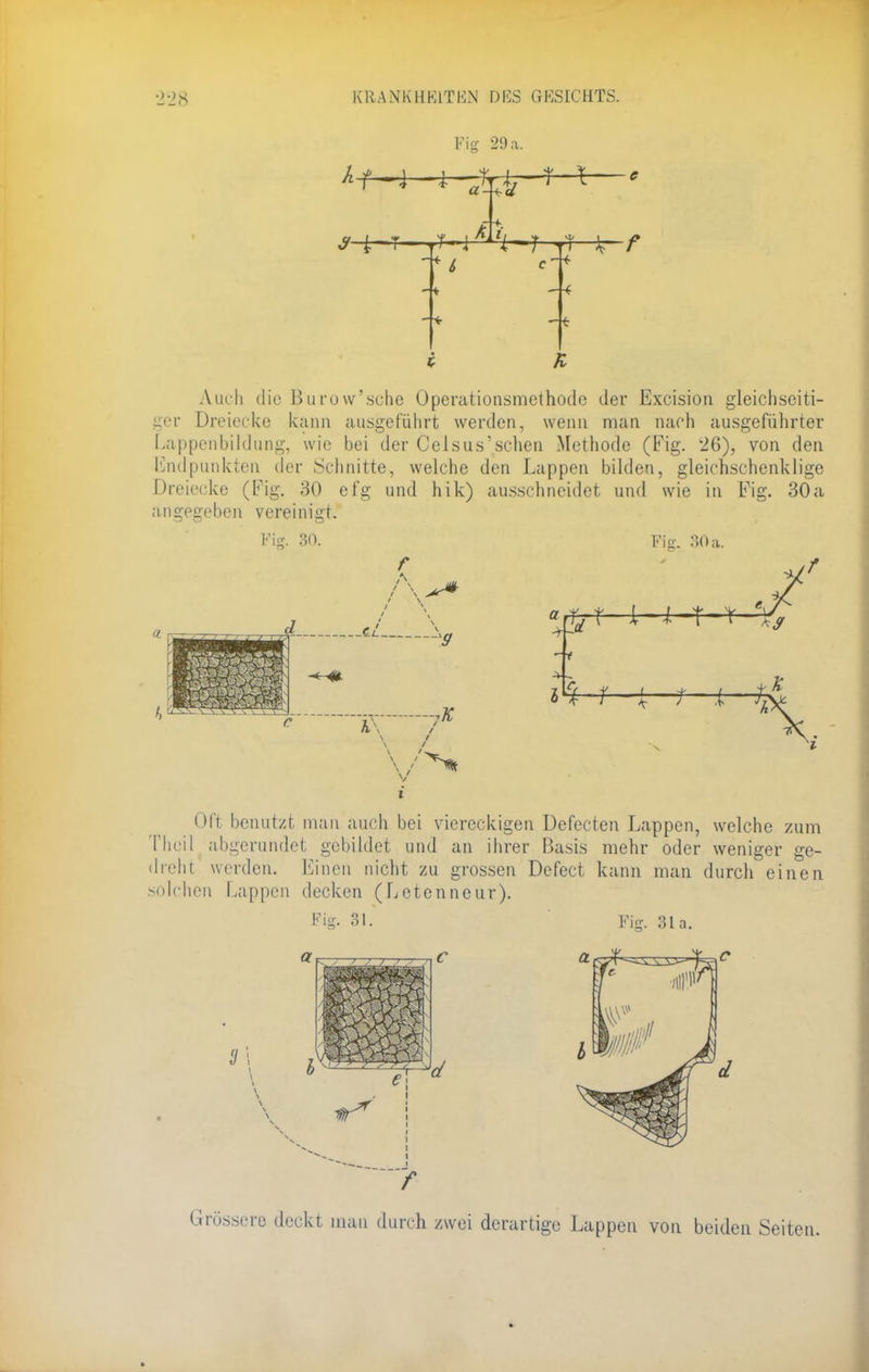 Fifi 29 a. A.uch die Burow'sche Operationsmethode der Excision gleichseiti- ger Dreiecke kann ausgeführt werden, wenn man nach ausgeführter Lappenbildung, wie bei der Celsus'sehen Methode (Fig. 26), von den Endpunkten der Schnitte, welche den Lappen bilden, gleichschenklige Dreiecke (Fig. 30 efg und hik) ausschneidet und wie in Fig. 30a angegeben vereinigt. v. 30. f V a Fig. 30a. % r ; ; i t K Oft benutzt man auch bei viereckigen Defecten Lappen, welche zum Thoil abgerundet gebildet und an ihrer Basis mehr oder weniger ge- dreht werden. Einen nicht zu grossen Defect kann man durch einen solchen Lappen decken (Letenneur). Fig. 31. Fi<r 3ia. Grössere deckt man durch zwei derartige Lappen von beiden Seiten.