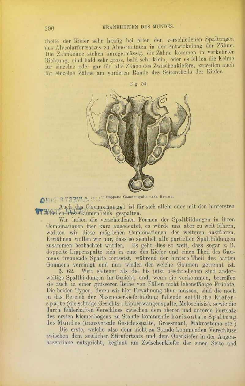 ■_>1)0 l heile der Kiefer sehr häufig bei allen den verschiedenen Spaltungen des Alveolar Fortsatzes zu Abnormitäten in der Entwicklung der Zahne. Die Zahnkeime stehen anregelmässig, die Zähne kommen in verkehrter Richtung, sind bald sehr gross, bald sehr klein, oder es fehlen die Kenne für einzelne oder gar für alle Zähne des Zvvischenkiefers, zuweilen auch für einzelne Zähne am vorderen Rande des Seitentheils der Kiefer. Fig. 54. _„Auch d^s.Gau,m,e.tt,s-&g.ftl ist für sich allein oder mit den hintersten ^feilen-'fTCS'^'äumenDeins gespalten. Wir haben die verschiedenen Formen der Spaltbildungen in ihren Combinationen hier kurz angedeutet, es würde uns aber zu weit führen, wollten wir diese möglichen Combinationen des weiteren ausführen. Erwähnen wollen wir nur, dass so ziemlich alle partiellen Spaltbildungen zusammen beobachtet wurden. Es geht dies so weit, dass sogar z. B. doppelte Lippenspalte sich in eine den Kiefer und einen Theil des Gau- mens trennende Spalte fortsetzt, während der hintere Theil des harten Gaumens vereinigt und nun wieder der weiche Gaumen getrennt ist. §. 62. Weit seltener als die bis jetzt beschriebenen sind ander- weitige Spaltbildungen im Gesicht, und, wenn sie vorkommen, betreffen sie auch in einer grösseren Reihe von Fällen nicht lebensfähige Früchte. Die beiden Typen, deren wir hier Erwähnung thun müssen, sind die noch in das Bereich der Nasenoberkieferbildung fallende seitliche Kiefer- spalte (die schräge Gesichts-, Lippenwangenspalte, Meloschisis), sowie die durch fehlerhaften Verschluss zwischen dem oberen und unteren Fortsatz des ersten Kiemenbogens zu Stande kommende horizontale Spaltung des Mundes (transversale Gesichtsspalte, Grossmaul, Makrostoma etc.) Die erste, welche also dem nicht zu Stande kommenden Verschluss zwischen dem seitlichen Stirnfortsatz und dem Oberkiefer in der Augen- nasenrinne entspricht, beginnt am Zwischenkiefer der einen Seite und