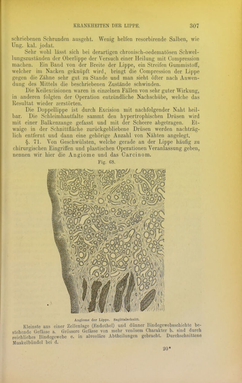 sehricbenen Schrunden ausgeht. Wenig helfen resorbirende Salben, wie Ung. kal. jodat. Sehr wohl lässt sich bei derartigen chroniseh-oedcmatösen Schwel- lungszuständen der Oberlippe der Versuch einer Heilung mit Conipression machen. Bin Band von der Breite der Lippe, ein Streifen Gummistoff, welcher im Nacken geknüpft wird, bringt die Comprcssion der Lippe gegen die Zähne sehr gut zu Stande und man sieht öfter nach Anwen- dung des Mittels die beschriebenen Zustände schwinden. Die Keilexcisionen waren in einzelnen Fällen von sehr guter Wirkung, in anderen folgten der Operation entzündliche Nachschübe, welche das Resultat wieder zerstörten. Die Doppellippe ist durch Excision mit nachfolgender Naht heil- bar. Die Schleimhautfalte sammt den hypertrophischen Drüsen wird mit einer Balkenzange gefasst und mit der Scheere abgetragen. Et- waige in der Schnittfläche zurückgebliebene Drüsen werden nachträg- lich entfernt und dann eine gehörige Anzahl von Nähten angelegt. §. 71. Von Geschwülsten, welche gerade an der Lippe häutig zu chirurgischen Eingriffen und plastischen Operationen Veranlassung geben, nennen wir hier die Angiome und das Carcinom. Fig. 68. Angiome der Lippe. Ssgittalschnitt. Kleinste aus einer Zellcnlage (Endothel) und dünner Bindegewebsschichte be- stehende Gefässe a. Grössere Gefässe von mehr venösem Charakter b. sind durch reichliches Bindegewebe c. in alveoläre Abtheilungen gebracht. Durchschnittene Muskelbündcl bei d. 20*
