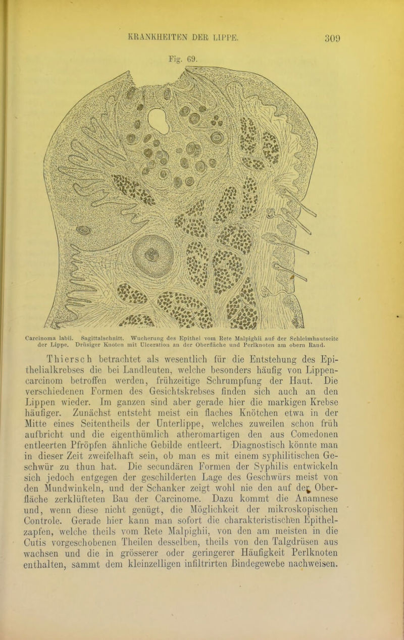 Fig. 69. Carcinoma labii. Sagittalschnitt. Wucherung des Epithel vom Rete Malpighü auf der Schleimhautseite der Lippe. Drüsiger Knoten mit Ulceration an der Oberfläche und Perlknoten am obern Hand. Thierse h betrachtet als wesentlich für die Entstehung des Epi- thelialkrebses die bei Landleuten, welche besonders häufig von Lippen- carcinom betroffen werden, frühzeitige Schrumpfung der Haut. Die verschiedenen Formen des Gesichtskrebses finden sich auch an den Lippen wieder. Im ganzen sind aber gerade hier die markigen Krebse häufiger. Zunächst entsteht meist ein flaches Knötchen etwa in der Mitte eines Seitentheils der Unterlippe, welches zuweilen schon früh aufbricht und die eigentümlich atheromartigen den aus Comedonen entleerten Pfropfen ähnliche Gebilde entleert. Diagnostisch könnte man in dieser Zeit zweifelhaft sein, ob man es mit einem syphilitischen Ge- schwür zu thun hat. Die secundären Formen der Syphilis entwickeln sich jedoch entgegen der geschilderten Lage des Geschwürs meist von den Mundwinkeln, und der Schanker zeigt wohl nie den auf der^ Ober- fläche zerklüfteten Bau der Carcinome. Dazu kommt die Anamnese und, wenn diese nicht genügt, die Möglichkeit der mikroskopischen Controle. Gerade hier kann man sofort die charakteristischen Epithel- zapfen, welche thcils vom Rete Malpighü, von den am meisten in die Cutis vorgeschobenen Theilen desselben, tbeüs von den Talgdrüsen aus wachsen und die in grösserer oder geringerer Häufigkeit Perlknoten enthalten, sammt dem kleinzelligen infiltrirten Bindegewebe nachweisen.