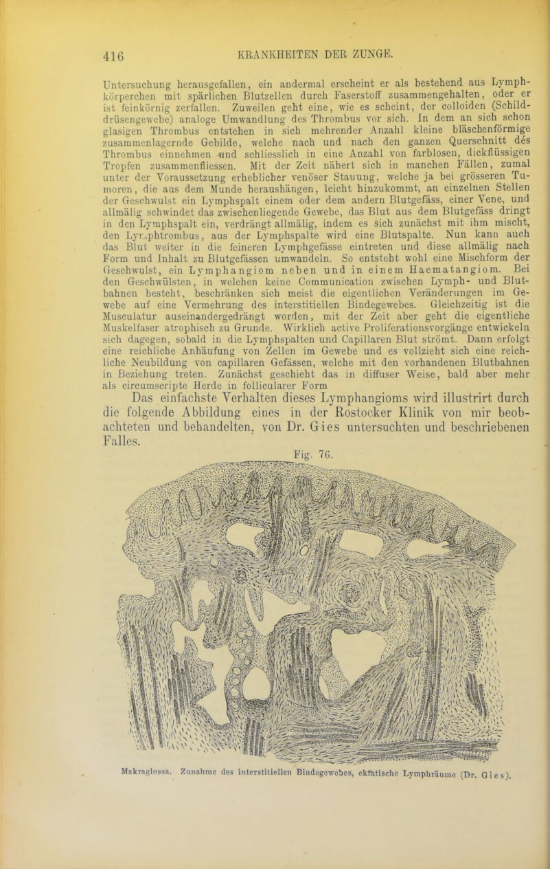 Untersuchung herausgefallen, ein andermal erscheint er als bestehend aus Lymph- körperchen mit spärlichen Blutzellcn durch Faserstoff zusammengehalten, oder er ist feinkörnig zerfallen. Zuweilen geht eine, wie es scheint, der colloiden (Schild- drüsengewebe) analoge Umwandlung des Thrombus vor sich. In dem an sich schon glasigen Thrombus entstehen in sich mehrender Anzahl kleine bläschenförmige zusaramenlagernde Gebilde, welche nach und nach den ganzen Querschnitt des Thrombus einnehmen und schliesslich in eine Anzahl von farblosen, dickflüssigen Tropfen zusammenfliessen. Mit der Zeit nähert sich in manchen Fällen, zumal unter der Voraussetzung erheblicher venöser Stauung, welche ja bei grösseren Tu- moren, die aus dem Munde heraushängen, leicht hinzukommt, an einzelnen Stellen der Geschwulst ein Lymphspalt einem oder dem andern Blutgefäss, einer Vene, und allmälig schwindet das zwischenliegende Gewebe, das Blut aus dem Blutgefäss dringt in den Lymphspalt ein, verdrängt allmälig, indem es sich zunächst mit ihm mischt, den Lyr.phtrombus, aus der Lymphspalte wird eine Blutspalte. Nun kann auch das Blut weiter in die feineren Lymphgefässe eintreten und diese allmälig nach Form und Inhalt zu Blutgefässen umwandeln. So entsteht wohl eine Mischform der Geschwulst, ein Lymphangiom neben und in einem Haematangiom. Bei den Geschwülsten, in welehen keine Communication zwischen Lymph- und Blut- bahnen besteht, beschränken sich meist die eigentlichen Veränderungen im Ge- webe auf eine Vermehrung des interstitiellen Bindegewebes. Gleichzeitig ist die Musculatur auseinandergedrängt worden, mit der Zeit aber geht die eigentliche Muskelfaser atrophisch zu Grunde. Wirklich active Proliferationsvorgänge entwickeln sich dagegen, sobald in die Lymphspalten und Capillaren Blut strömt. Dann erfolgt eine reichliche Anhäufung von Zellen im Gewebe und es vollzieht sich eine reich- liche Neubildung von capillaren Gefässen, welche mit den vorhandenen Blutbahnen in Beziehung treten. Zunächst geschieht das in diffuser Weise, bald aber mehr als circumscripte Herde in follicularer Form Das einfachste Verhalten dieses Lymphangioms wird illustrirt durch die folgende Abbildung eines in der Rostocker Klinik von mir beob- achteten und behandelten, von Dr. Gies untersuchten und beschriebenen Falles. Fig. 76. Makrnsclnssa. Zunahme des interstitiellen Bindegewebes, cktntische Lymphräume (Dr. Gies).
