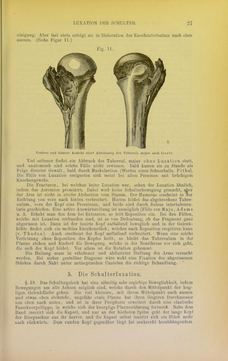 einigung. Aber fast stets erfolgt sie in Dislocation des Knoehenfortsatzcs nach oben aussen. (Siehe Figur 11.) Fig. 11. Vordere und hintere Ansicht einer Abreissung des Tubercul. majus nach (iurlt. Viel seltener findet ein Abbruch des Tubercul. majus ohne Luxation statt, und anatomisch sind solche Fälle nicht erwiesen. Bald kamen sie zu Stande als Folge directer Gewalt, bald durch Muskelaction (Werfen eines Schneeballs, Pitha). Die Fälle von Luxation ereigneten sich meist bei alten Personen mit brüchigem Knochengewebe. Die Fracturen, bei welchen keine Luxation war, sehen der Luxation ähnlich, indem das Acromion prominirt. Dabei wird keine Schulterbewegung gemacht, aber der Arm ist nicht in steifer Abduction vom Stamm. Der Humerus erscheint in aer Richtung von vorn nach hinten verbreitert. Hinten bildet das abgebrochene Tuber- culum, vorn der Kopf eine Prominenz, und beide sind durch Sulcus intertubercu- laris geschieden. Eine active Auswärtsrollung ist unmöglich (Fälle von Majo, Adams u. A. Erhebt man den Arm bei Extension, so tritt Reposition ein. Bei den Fällen, welche mit Luxation verbunden sind, ist es von Bedeutung, ob das Fragment ganz abgerissen ist. Dann ist der luxirte Kopf auffallend beweglich und in der Gelenk- höhle findet sich ein mobiles Knochenstück, welches nach Reposition crepitiren kann (v. Thaden). Auch erscheint der Kopf auffallend verbreitert. Wenn eine solche Verletzung ohne Reposition des Kopfes heilt, so bleibt das Tuberculum in der Pfanne stehen und hindert die Bewegung, welche in der Nearthrose vor sich gehl, die sich der Kopf bildet. Vor allem ist die Rotation gehemmt. Die Heilung muss in erhobener und abducirtcr Stellung des Arms versucht werden. Bei sicher gestellter Diagnose wäre wohl eine Fixation des abgerissenen Stückes durch Naht unter antiseptischen Cautelen die richtige Behandlung. 5. Die Schulterluxation. §. l'J. Das Schultergclenk hat eine allseitig sehr ergiebige Beweglichkeit, indem Bewegungen um alle Achsen möglich sind, welche durch den Mittelpunkt der kug- ligen Gclenklläche gehen. Die viel kleinere, mit ihrem Mittelpunkt nach aussen und etwas oben stehende, ungefähr ovale Pfanne hat ihren längeren Durchmesser von oben nach unten, und ist in ihrer Peripherie erweitert durch eine elastische Faserknorpellippe, in welche sich der knorplige Pfanncniiberzug fortsetzt. Nahe dem Rand inscrirt sich die Kapsel, und nur an der höchsten Spitze geht der lange Kopf der Biccpssehne aus ihr hervor, und die Kapsel selbst inserirt sich ein Stück mehr nach rückwärts. Dem runden Kopf gegenüber liegt bei senkrecht herabhängendem