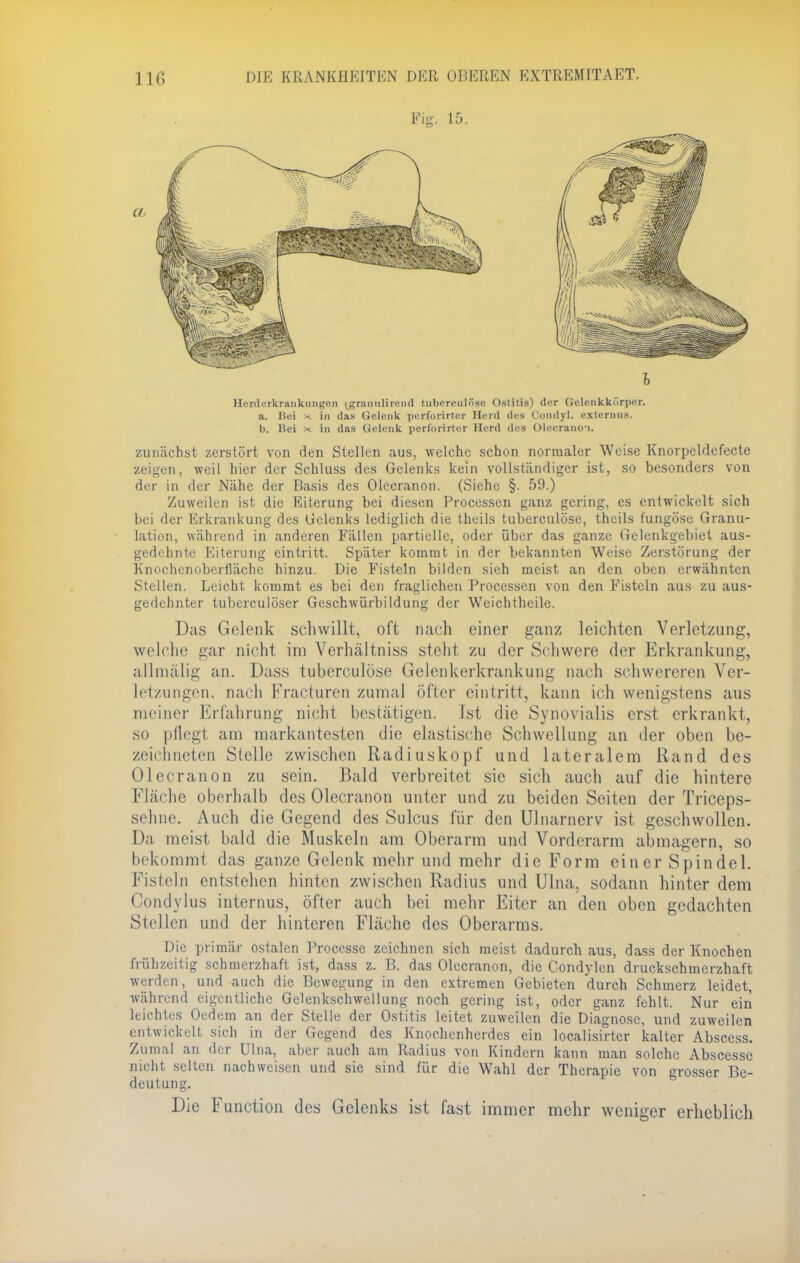 I Herderkrankungen ^grannlirend tuberculnse Ostitis) der Gelcnkkörper. a. Jiui * in das Gelenk perforirter Herd des Condyl. externus. b. Bei x. In das Gelenk perforirter Herd des Oler-.rano-i. zunächst zerstört von den Stellen aus, welche schon normaler Weise Knorpeldefecte zeigen, weil hier der Schluss des Gelenks kein vollständiger ist, so besonders von der in der Nähe der Basis des Olecranon. (Siehe §. 59.) Zuweilen ist die Eiterung bei diesen Processen ganz gering, es entwickelt sich bei der Erkrankung des Gelenks lediglich die theils tuberculöse, theils fungöse Granu- lation, während in anderen Fällen partielle, oder über das ganze Gelenkgebiet aus- gedehnte Eiterung eintritt. Später kommt in der bekannten Weise Zerstörung der Knochcnoberfläche hinzu. Die Fisteln bilden sieh meist an den oben erwähnten Stellen. Leicht kommt es bei den fraglichen Processen von den Fisteln aus zu aus- gedehnter tuberculöser Gcschwürbildung der Weichtheile. Das Gelenk schwillt, oft nach einer ganz leichten Verletzuni;, welche gar nicht im Verhältniss steht zu der Schwere der Erkrankung, allmälig an. Dass tuberculöse Gelenkerkrankung nach schwereren Ver- letzungen, nach Fracturen zumal öfter eintritt, kann ich wenigstens aus meiner Erfahrung nicht bestätigen. Ist die Synovialis erst erkrankt, so pflegt am markantesten die elastische Schwellung an der oben be- zeichneten Stelle zwischen Radiuskopf und lateralem Rand des Olecranon zu sein. Bald verbreitet sie sich auch auf die hintere Fläche oberhalb des Olecranon unter und zu beiden Seiten der Triceps- sehne. Auch die Gegend des Sulcus für den Ulnarnerv ist geschwollen. Da meist bald die Muskeln am Oberarm und Vorderarm abmagern, so bekommt das ganze Gelenk mehr und mehr die Form einer Spindel. Fisteln entstehen hinten zwischen Radius und Ulna, sodann hinter dem Condvlus internus, öfter auch bei mehr Eiter an den oben gedachten Stellen und der hinteren Fläche des Oberarms. Die primär ostalen Proccsse zeichnen sich meist dadurch aus, dass der Knochen frühzeitig schmerzhaft ist, dass z. B. das Olecranon, die Condylen druckschmerzhaft werden, und auch die Bewegung in den extremen Gebieten durch Schmerz leidet, während eigentliche Gelenkschwellung noch gering ist, oder ganz fehlt. Nur ein Leichtes Oedem an der Stelle der Ostitis leitet zuweilen die Diagnose, und zuweilen entwickelt sich in der Gegend des Knochenherdes ein localisirter kalter Abscess. Zumal an der Ulna, aber auch am Radius von Kindern kann man solche Abscessc nicht selten nachweisen und sie sind für die Wahl der Therapie von grosser Be- deutung. Die Function des Gelenks ist fast immer mehr weniger erheblich