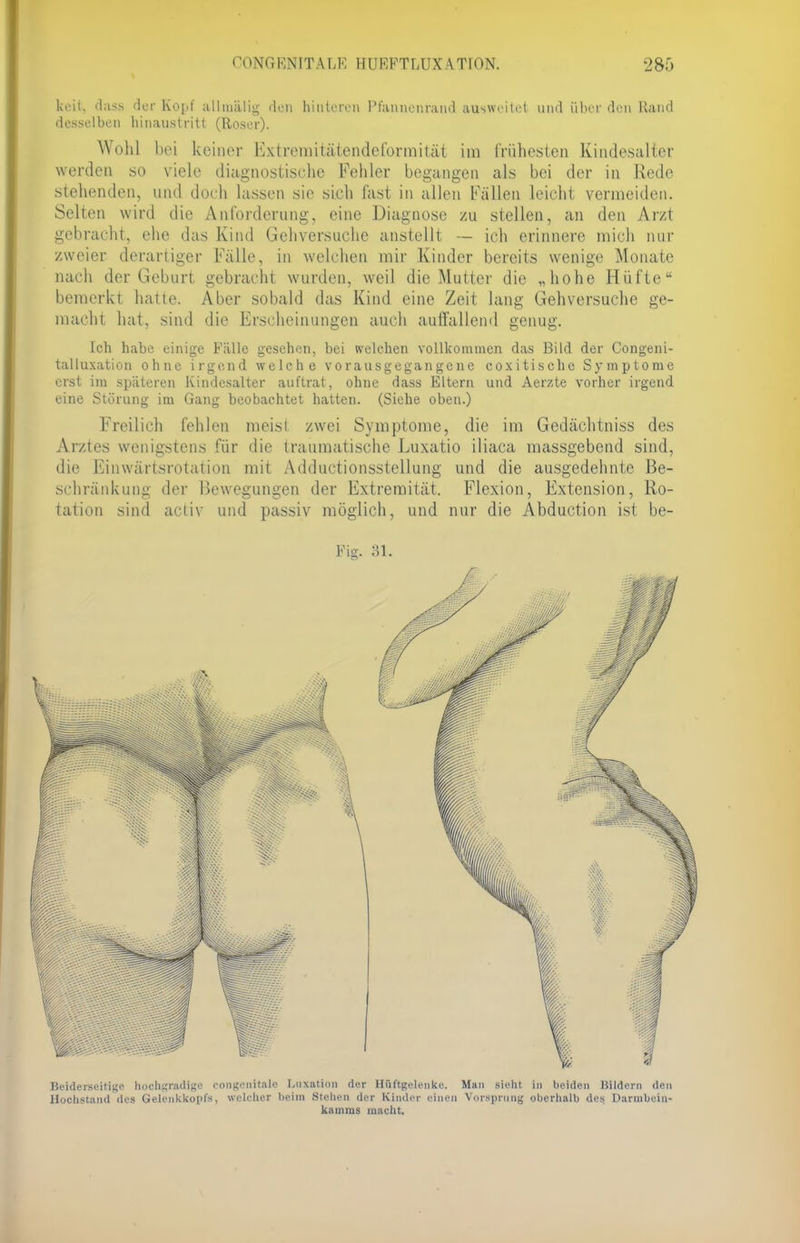 keit, dass der Kopf allmälig den hinteren Pfannenrand ausweitet und über den Rand desselben hinaustritt (Roser). Wohl bei keiner Extremitätendcformität im frühesten Kindesalter werden so viele diagnostische Fehler begangen als bei der in Rede stehenden, und doch hissen sie sieh last in allen Fallen leicht vermeiden. Selten wird die Anforderung, eine Diagnose zu stellen, an den Arzt gebracht, ehe das Kind Gehversuche anstellt — ich erinnere mich nur zweier derartiger Fälle, in welchen mir Kinder bereits wenige Monate nach der Geburt gebracht wurden, weil die Mutter die „hohe Hüfte bemerkt hatte. Aber sobald das Kind eine Zeit lang Gehversuche ge- macht hat, sind die Erscheinungen auch auffallend genug. Ich habe einige Fälle gesehen, bei welchen vollkommen das Bild der Congeni- talluxation ohne irgend welche vorausgegangene coxitische Symptome erst im späteren Kindesalter auftrat, ohne dass Eltern und Aerzte vorher irgend eine Störung im Gang beobachtet hatten. (Siehe oben.) Freilich fehlen meisl zwei Symptome, die im Gedächtniss des Arztes wenigstens für die traumatische Luxatio iliaca massgebend sind, die Einwärtsrotation mit Adductionsstellung und die ausgedehnte Be- schränkung der Bewegungen der Extremität. Flexion, Extension, Ro- tation sind activ und passiv möglich, und nur die Abduction ist be- Fig. 31. Beiderseitige hochgradige rongenitale Luxation der Hüftgelenke. Man sieht in beiden Hildern den Hochstand des Gelenkkopfs, welcher beim Stehen der Kinder einen Vorsprang oberhalb des Darnibein- kamms macht.
