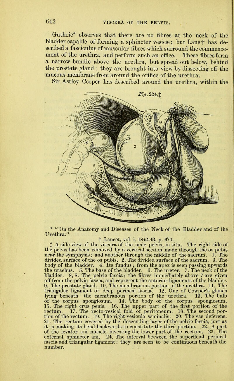 Guthrie* observes that there are no fibres at the neck of the bladder capable of forming a sphincter vesicae; but Lanef has de- scribed a fasciculus of muscular fibres which surround the commence- ment of the urethra, and perform such an office. These fibres form a narrow bundle above the urethra, but spread out below, behind the prostate gland; they are brought into view by dissecting off the mucous membrane from around the orifice of the urethra. Sir Astley Cooper has described around the urethra, within the *  On the Anatomy and Diseases of the Neck of the Bladder and of the Urethra. t Lancet, vol. i. 1842-43, p. 670. % A side view of the viscera of the male pelvis, in situ. The right side of the pelvis has been removed by a vertical section made through the os pubis near the symphysis; and another through the middle of the sacrum. 1. The divided surface of the os pubis. 2. The divided surface of the sacrum. 3. The body of the bladder. 4. Its fundus ; from the apex is seen passing upwards the urachus. 5. The base of the bladder. 6. The ureter. 7. The neck of the bladder. 8, 8. The pelvic fascia; the fibres immediately above 7 are given off from the pelvic fascia, and represent the anterior ligaments of the bladder. 9. The prostate gland. 10. The membranous portion of the urethra. 11. The triangular hgament or deep perineal fascia. 12. One of Cowper's glands lying beneath the membranous portion of the urethra. 13. The bulb of the corpus spongiosum. 14. The body of the corpus spongiosum. 15. The right crus penis. 16. The upper part of the first portion of the rectum. 17. The recto-vesical fold of peritoneum. 18. The second por- tion of the rectum. 19. The right vesicula seminahs. 20. The vas deferens. 21. The rectum covered by the descending layer of the pelvic fascia, just as it is making its bend backwards to constitute the third portion. 22. A part of the levator ani muscle investing the lower part of the rectum. 23. The external sphincter ani. 24. The interval between the superficial perineal fascia and triangular ligament: they are seen to be continuous beneath the number.