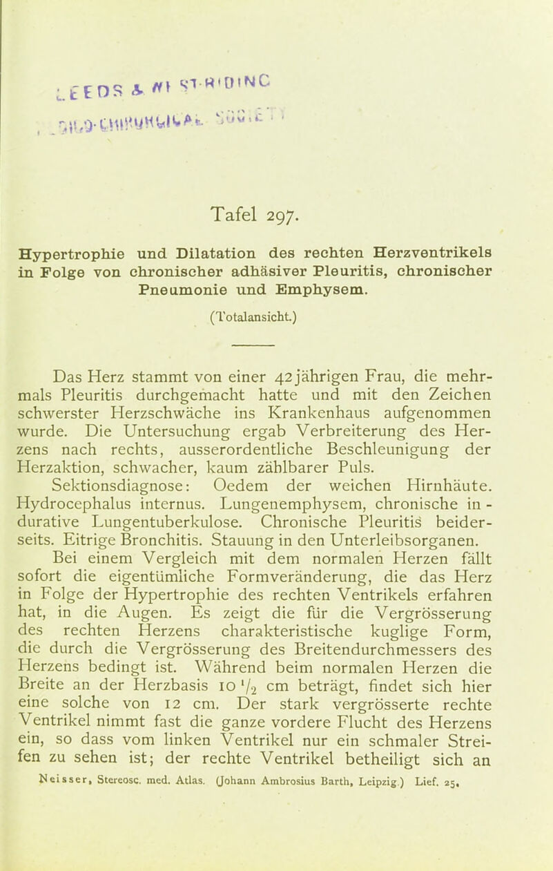 Hypertrophie und Dilatation des rechten Herzventrikels in Folge von chronischer adhäsiver Pleuritis, chronischer Pneumonie und Emphysem. (Totalansicht.) Das Herz stammt von einer 42 jährigen Frau, die mehr- mals Pleuritis durchgemacht hatte und mit den Zeichen schwerster Herzschwäche ins Krankenhaus aufgenommen wurde. Die Untersuchung ergab Verbreiterung des Her- zens nach rechts, ausserordentliche Beschleunigung der Herzaktion, schwacher, kaum zählbarer Puls. Sektionsdiagnose: Oedem der weichen Hirnhäute. Hydrocephalus internus. Lungenemphysem, chronische in - durative Lungentuberkulose. Chronische Pleuritis beider- seits. Eitrige Bronchitis. Stauung in den Unterleibsorganen. Bei einem Vergleich mit dem normalen Herzen fällt sofort die eigentümliche Formveränderung, die das Herz in Folge der Hypertrophie des rechten Ventrikels erfahren hat, in die Augen. Es zeigt die für die Vergrösserung des rechten Herzens charakteristische kuglige Form, die durch die Vergrösserung des Breitendurchmessers des Herzens bedingt ist. Während beim normalen Herzen die Breite an der Herzbasis 10 l/2 cm beträgt, findet sich hier eine solche von 12 cm. Der stark vergrösserte rechte Ventrikel nimmt fast die ganze vordere Flucht des Herzens ein, so dass vom linken Ventrikel nur ein schmaler Strei- fen zu sehen ist; der rechte Ventrikel betheiligt sich an