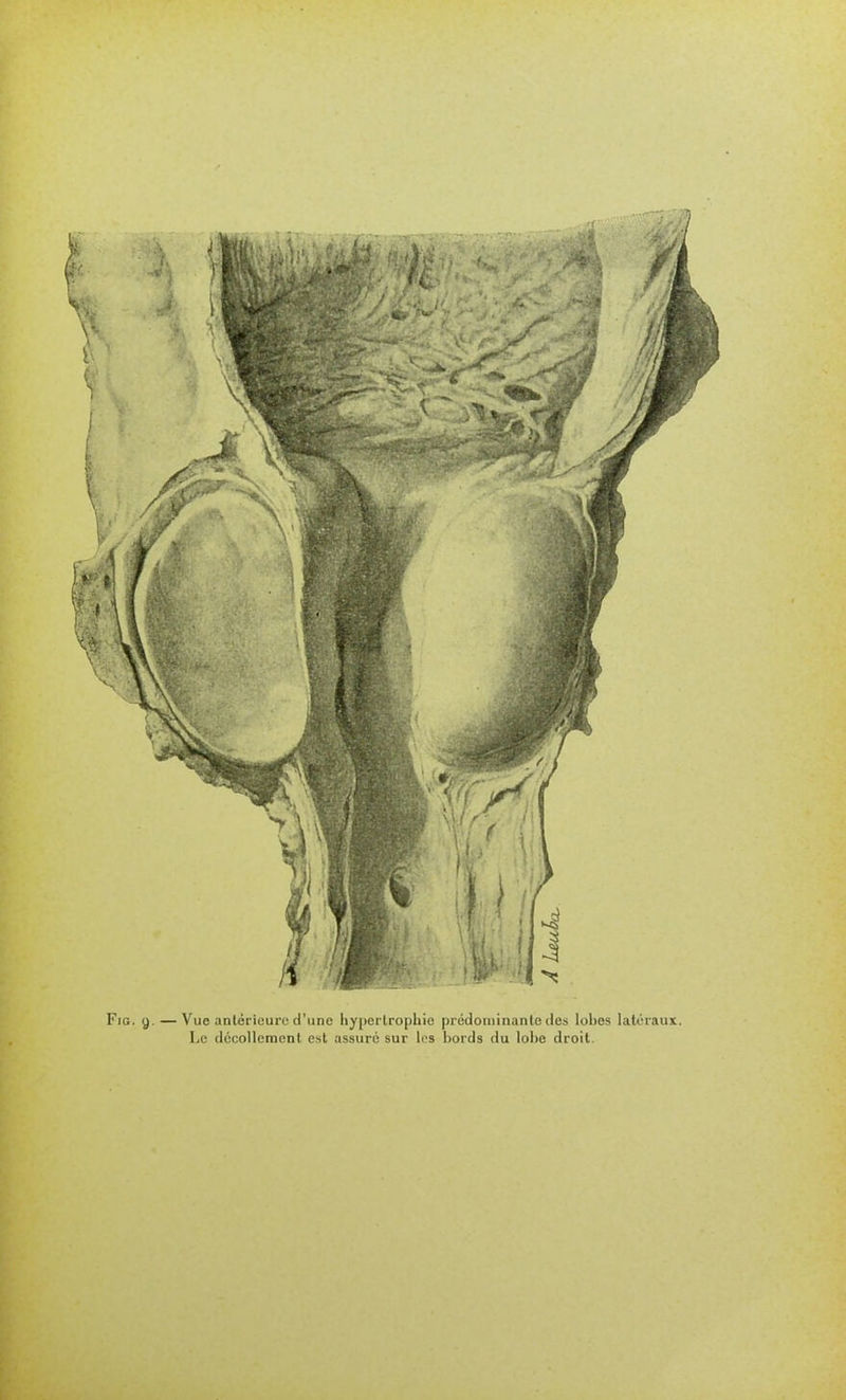 FiG. g. — Vue antérieure d'une liyperlropliie |)rédouiinante des lobes latéraux. Le dccoUeraenl est assuré sur ii's bords du lobe droit.