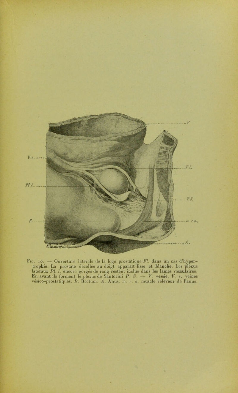 Fk;. 10. — Oiivcriurc latérale do la loge prostatique Fl. dans un cas d'iiyper- Irophie. La prostate décollée nu doigt apparaît lisse et blanche. Les plexus latéraux Pl. l. encore gorges de sang restent inclus dans les lames vasculaires. En avant ils f'ornient le plexus de Santorini P. S. — V. vessie. V s. veines