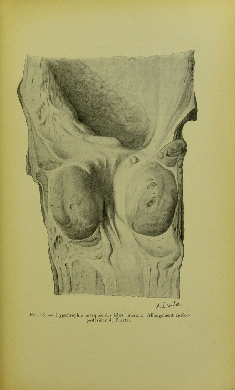 FiG. i3. — Hypertrophie niarquoe des lobes latéraux Allongement antéro postérieur du l'urètre.