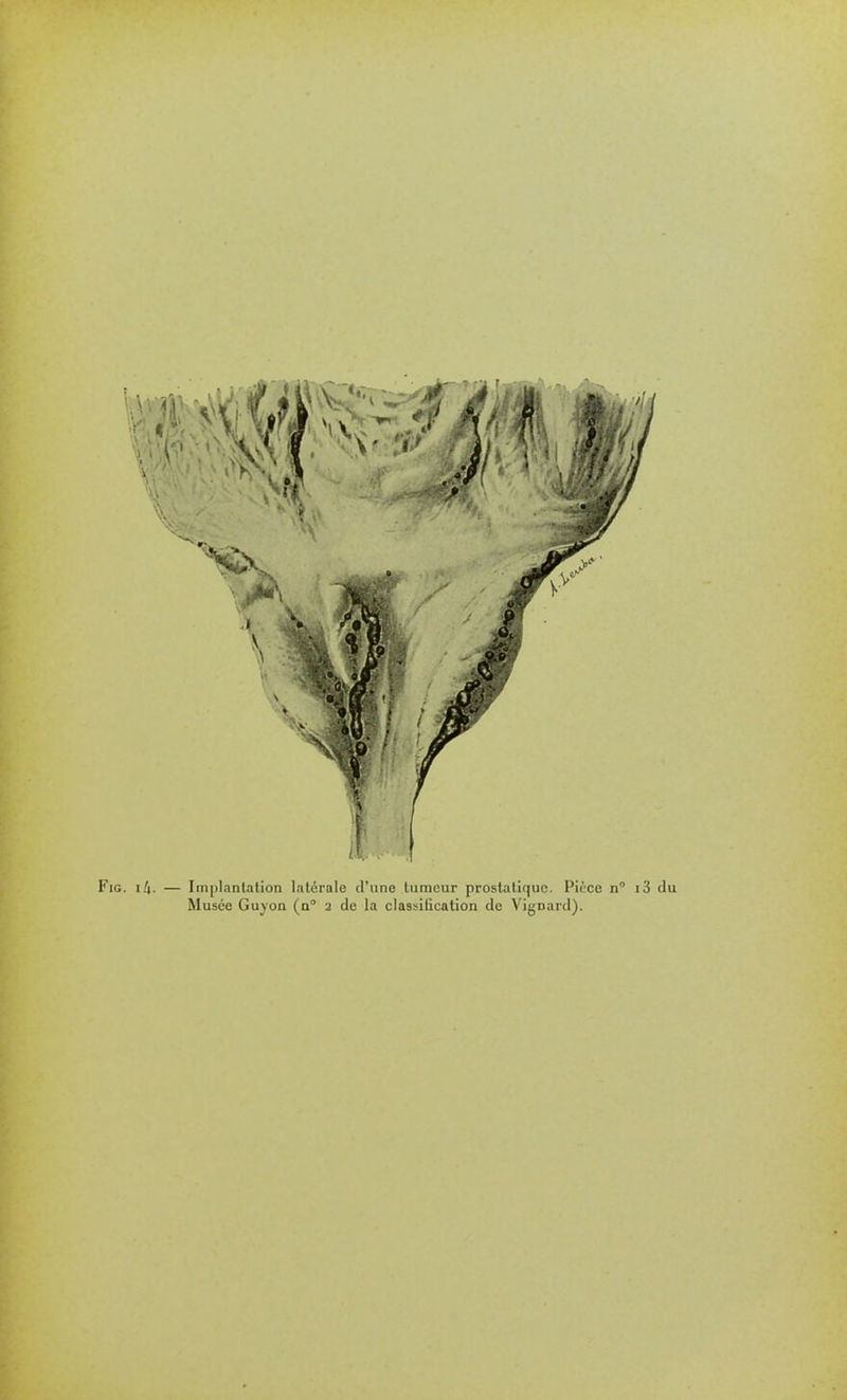 FiG. i/i. — Implantation latérale d'une tumeur prostatique. Pièce n i3 du Musée Guyon (n 2 de la classidcation de Vignard).