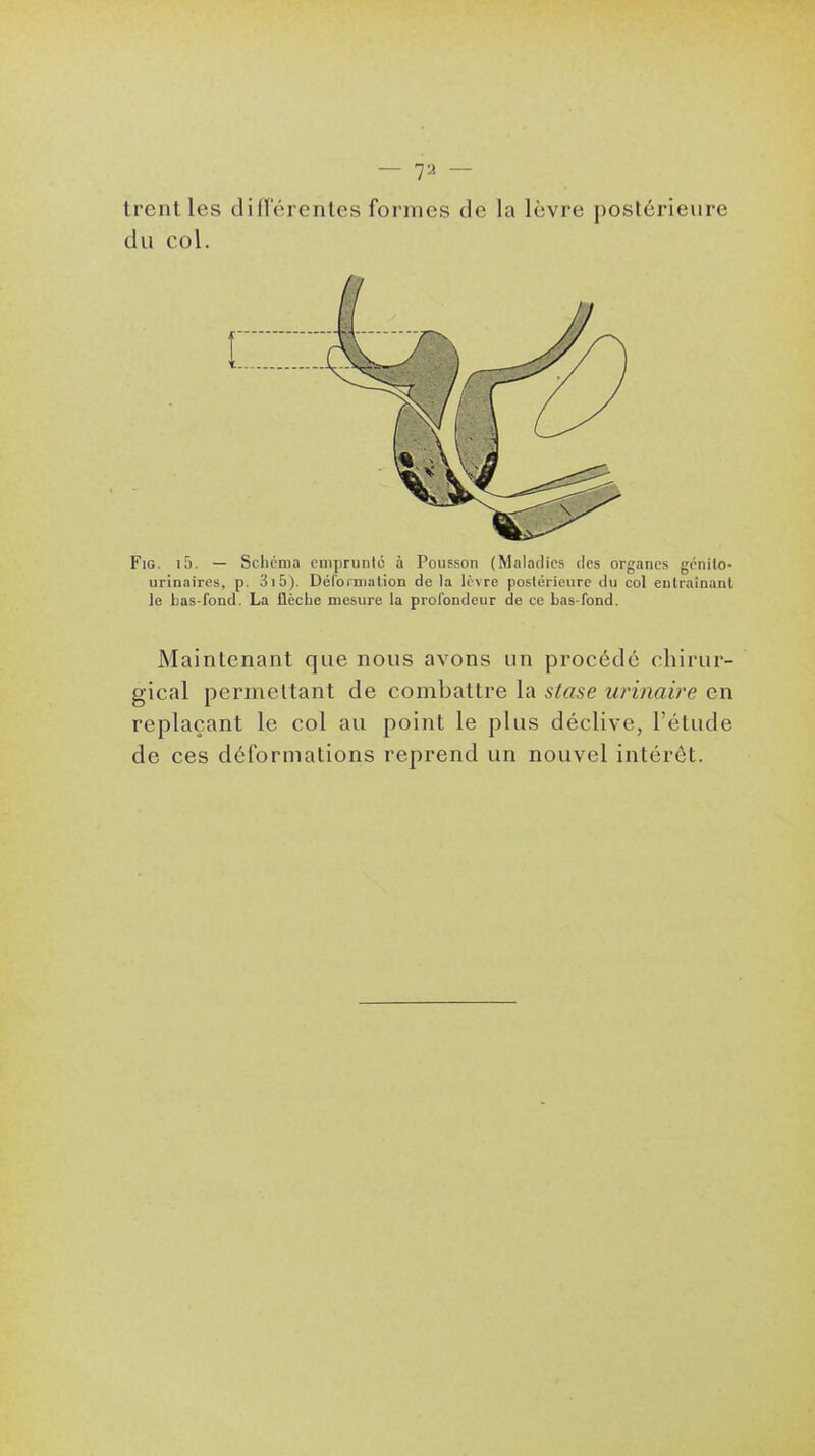 trentles diiï'érenles formes de la lèvre postérieure du col. FiG. i5. — Scliéma emprunte à Pousson (Maladies des organes génilo- urinaires, p. 3i5). Déloimation de la lèvre postérieure du col eulraînanl le bas-fond. La flèche mesure la profondeur de ce Las-fond. Maintenant que nous avons un procédé chirur- gical permettant de combattre la stase winaire en replaçant le col au point le plus déclive, l'élude de ces déformations reprend un nouvel intérêt.