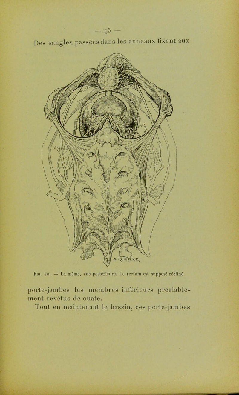-95- Des sangles passées clans les anneaux fixent aux FiG. 20. — La même, vuo postérieure. Le rectum est supposé récliné. porte-jambes les membres inférieurs préalable- ment revêtus de ouate. Tout en maintenant le bassin, ces porte-jambes