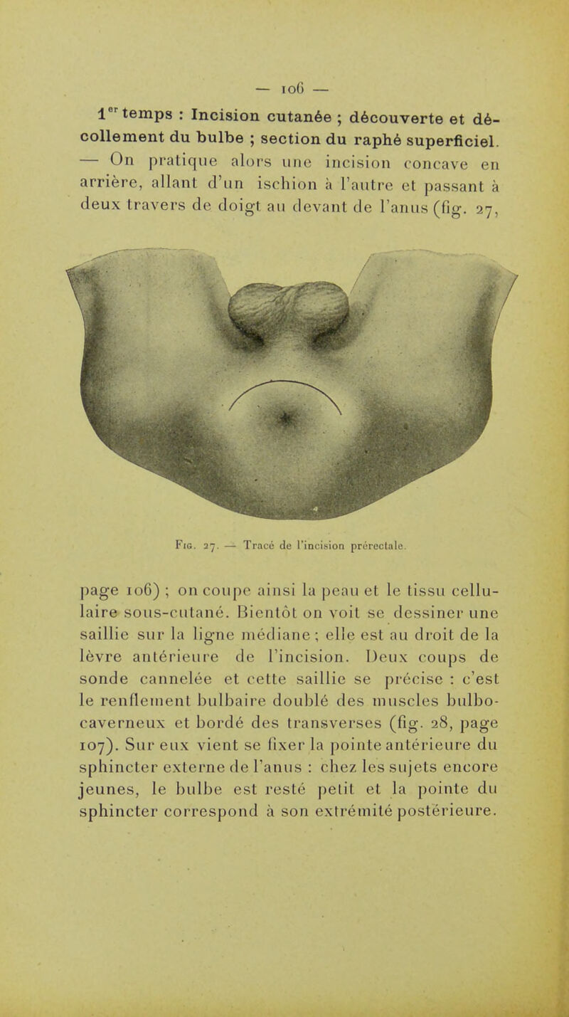 1 temps : Incision cutanée ; découverte et dé- collement du bulbe ; section du raphé superficiel. — On pratique alors une incision concave en arrière, allant d'un ischion à l'autre et passant à deux travers de doigt au devant de l'anus (fig. 27, FiG. 37. — Tracé de l'incision prérectale. jiage 106) ; on coupe ainsi la peau et le tissu cellu- laire sous-cutané. Bientôt on voit se dessiner une saillie sur la ligne médiane; elle est au droit de la lèvre antérieure de l'incision. Deux coups de sonde cannelée et cette saillie se précise : c'est le renflement bulbaire doublé des muscles bulbo- caverneux et bordé des transverses (fig. 28, page 107). Sur eux vient se fixer la pointe antérieure du sphincter externe de l'anus : chez les sujets encore jeunes, le bulbe est resté petit et la pointe du sphincter correspond à son extrémité postérieure.