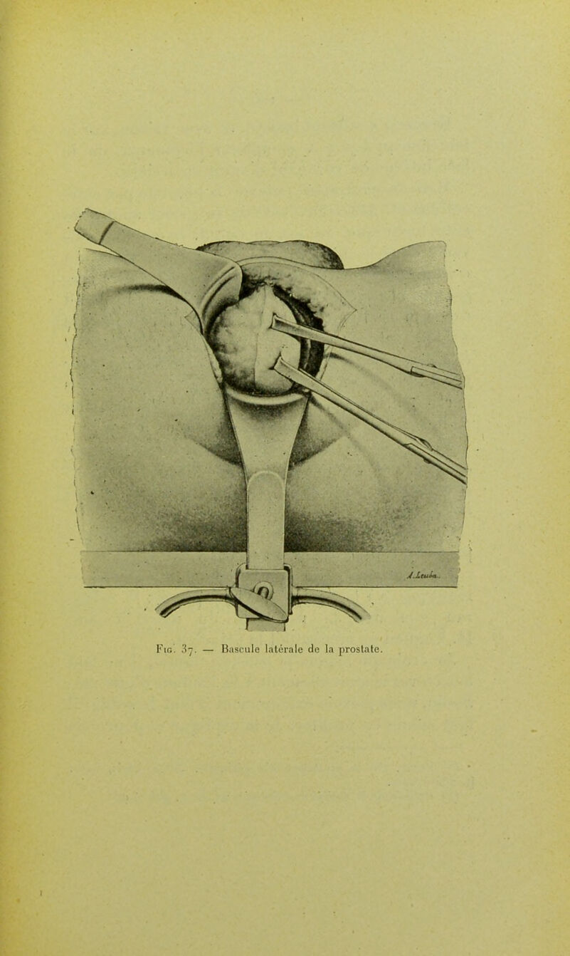 FiG. 37. — B.iscuie latérale de la prostate