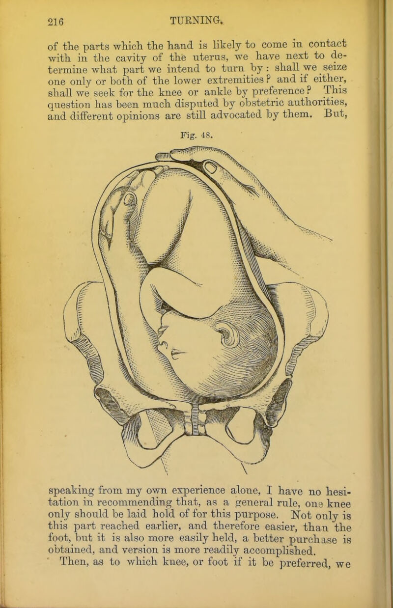 of the parts wliicli the hand is likely to come iti contact with in the cavity of the uterus, we have next to de- termine what part we intend to turn by: shall we seize one only or both of the lower extremities ? and if either, shall we seek for the knee or ankle by preference ? This question has been much disputed by obstetric authorities, and different opinions are still advocated by them. But, Fig. 48. speaking from my own experience alone, I have no hesi- tation in recommending that, as a general rule, one knee only should be laid hold of for this purpose. Not only is this part reached earlier, and therefore easier, than the foot, but it is also more easily held, a better purchase is obtained, and version is more readily accomplished. Then, as to wliich knee, or foot if it be preferred, we