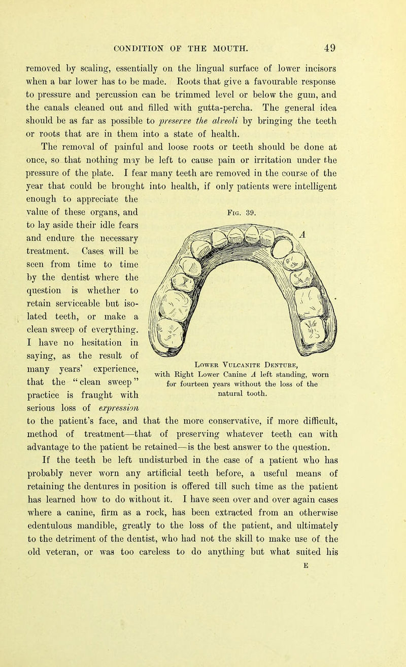 removed by scaling, essentially on the lingual surface of lower incisors when a bar lower has to be made. Roots that give a favourable response to pressure and percussion can be trimmed level or below the gum, and the canals cleaned out and filled with gutta-percha. The general idea should be as far as possible to preserve the alveoli by bringing the teeth or roots that are in them into a state of health. The removal of painful and loose roots or teeth should be done at Once, so that nothing may be left to cause pain or irritation under the pressure of the plate. I fear many teeth are removed in the course of the year that could be brought into health, if only patients were intelligent enough to appreciate the value of these organs, and to lay aside their idle fears and endure the necessary treatment. Cases will be seen from time to time by the dentist where the question is whether to retain serviceable but iso- lated teeth, or make a clean sweep of everything. I have no hesitation in saying, as the result of many years' experience, that the  clean sweep practice is fraught with serious loss of expression to the patient's face, and that the more conservative, if more difficult, method of treatment—that of preserving whatever teeth can with advantage to the patient be retained—is the best answer to the question. If the teeth be left undisturbed in the case of a patient who has probably never worn any artificial teeth before, a useful means of retaining the dentures in position is offered till such time as the patient has learned how to do without it. I have seen over and over again cases where a canine, firm as a rock, has been extracted from an otherwise edentulous mandible, greatly to the loss of the patient, and ultimately to the detriment of the dentist, who had not the skill to make use of the old veteran, or was too careless to do anything but what suited his E Fig. 39. Lower Vulcanite Denture, with Eight Lower Canine A left standing, worn for fourteen years without the loss of the natural tooth.