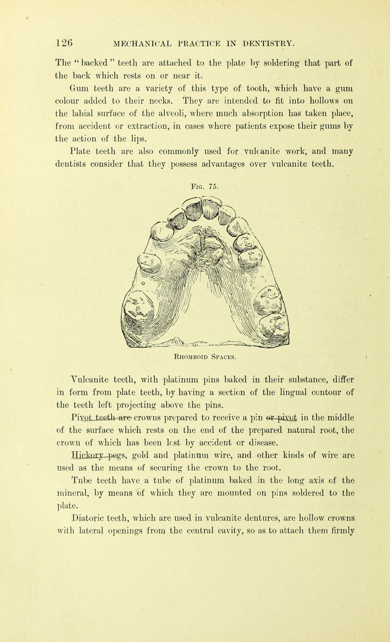 The  backed  teeth, are attached to the plate by soldering that part of the back which rests on or near it. Gum teeth are a variety of this type of tooth, which have a gum colour added to their necks. They are intended to fit into hollows on the labial surface of the alveoli, where much absorption has taken place, from accident or extraction, in cases where patients expose their gums by the action of the lips. Plate teeth are also commonly used for vulcanite work, and many dentists consider that they possess advantages over vulcanite teeth. Fig. 75. Rhomboid Spaces. Vulcanite teeth, with platinum pins baked in their substance, differ in form from plate teeth, by having a section of the lingual contour of the teeth left projecting above the pins. Pivot-teeth-a-re-' crowns prepared to receive a pin ©*-pivut in the middle of the surface which rests on the end of the prepared natural root, the crown of which has been lest by accident or disease. Hifknry -pags; gold and platinum wire, and other kinds of wire are used as the means of securing the crown to the root. Tube teeth have a tube of platinum baked in the long axis of the mineral, by means of which they are mounted on pins soldered to the plate. Diatoric teeth, which are used in vulcanite dentures, are hollow crowns with lateral openings from the central cavity, so as to attach them firmly