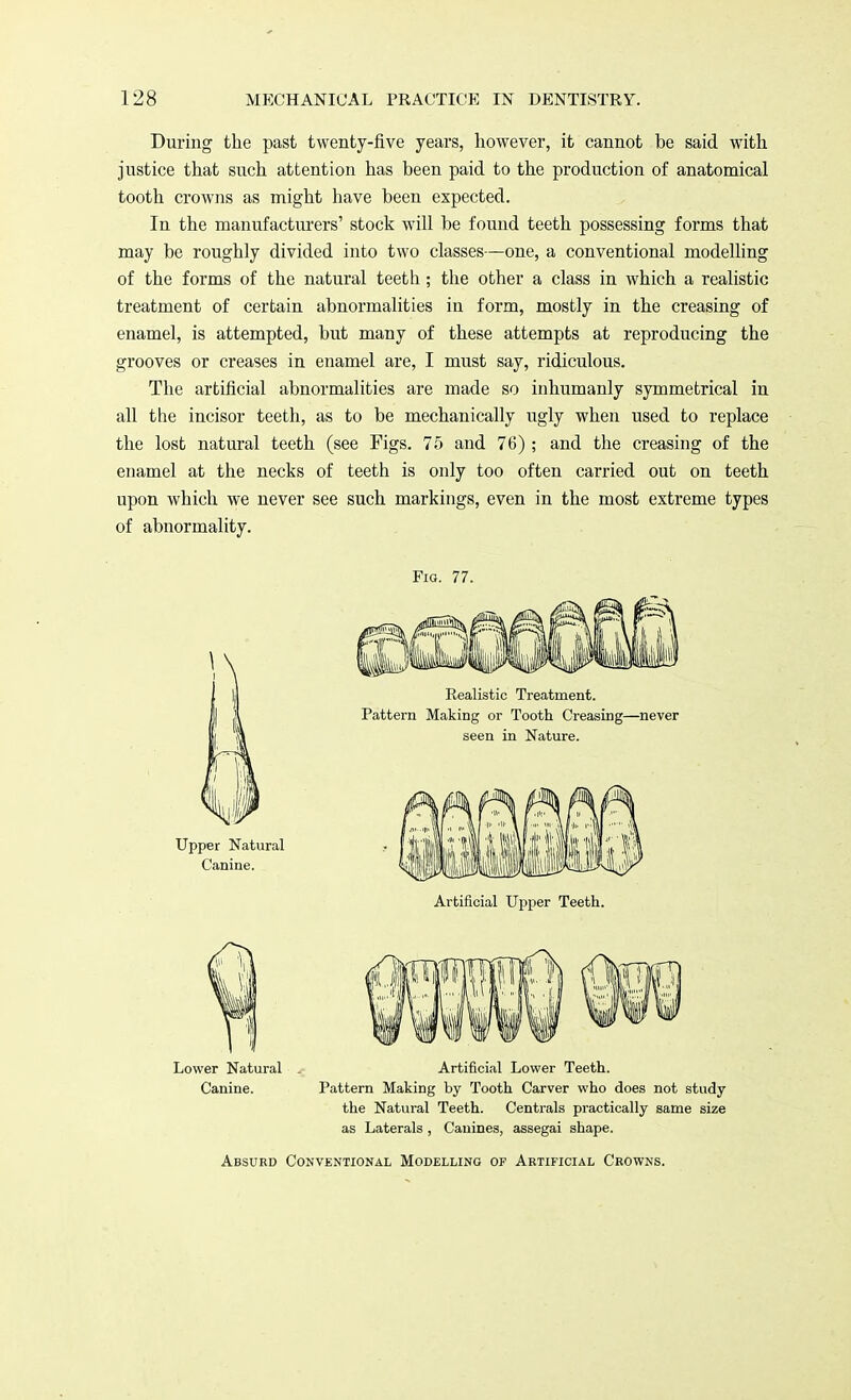 During the past twenty-five years, however, it cannot be said with justice that such attention has been paid to the production of anatomical tooth crowns as might have been expected. In the manufacturers' stock will be found teeth possessing forms that may be roughly divided into two classes—one, a conventional modelling of the forms of the natural teeth ; the other a class in which a realistic treatment of certain abnormalities in form, mostly in the creasing of enamel, is attempted, but many of these attempts at reproducing the grooves or creases in enamel are, I must say, ridiculous. The artificial abnormalities are made so inhumanly symmetrical in all the incisor teeth, as to be mechanically ugly when used to replace the lost natural teeth (see Figs. 75 and 76) ; and the creasing of the enamel at the necks of teeth is only too often carried out on teeth upon which we never see such markings, even in the most extreme types of abnormality. Fig. 77. Realistic Treatment. Pattern Making or Tooth Creasing—never seen in Nature. Upper Natural Canine. Artificial Upper Teeth. Lower Natural Canine. Artificial Lower Teeth. Pattern Making by Tooth Carver who does not study the Natural Teeth. Centrals practically same size as Laterals , Canines, assegai shape. Absurd Conventional Modelling of Artificial Crowns.