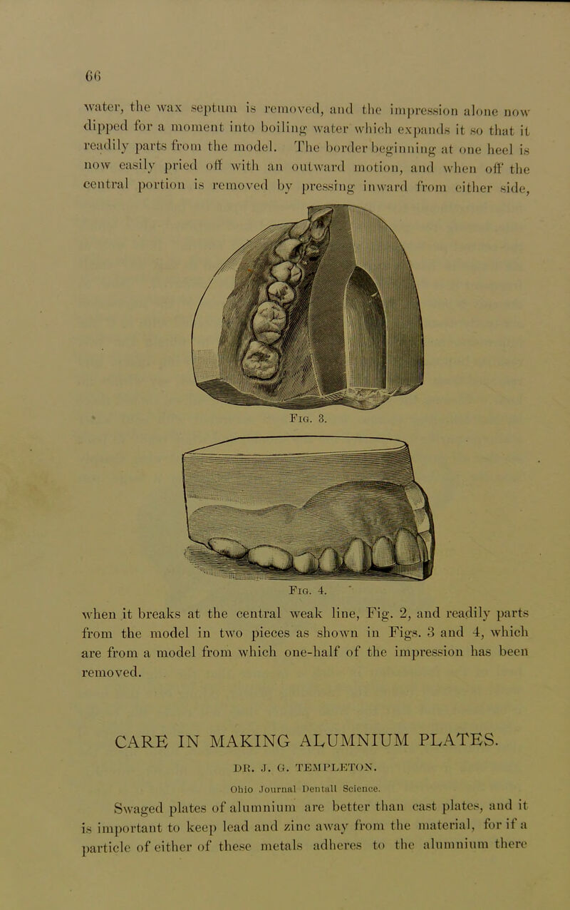 G6 water, the wax septum is removed, and the impression alone now dipped for a moment into boiling water which expands it so that it readily parts from the model. The border beginning at one heel is now easily pried off with an outward motion, and when off the central portion is removed by pressing inward from either side, Fig. 4. when it breaks at the central weak line, Fig. 2, and readily parts from the model in two pieces as shown in Figs. 3 and 4, which are from a model from which one-half of the impression has been removed. CARE IN MAKING ALUMNIUM PLATES. DR. J. G. TEMPLETON. Ohio Journal Dentall Science. Swaged plates of alumnium are better than cast plates, and it is important to keep lead and zinc away from the material, for if a particle of either of these metals adheres to the alumnium there