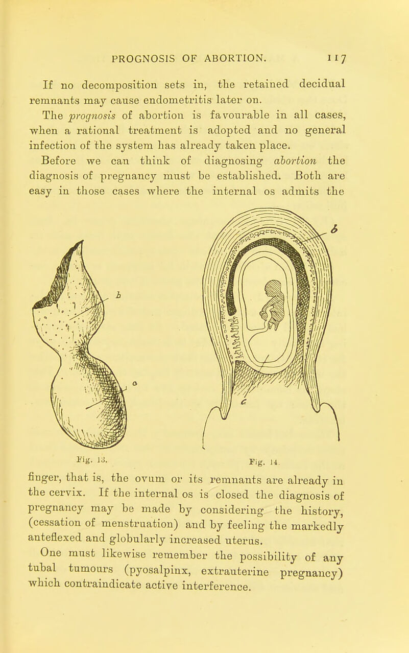 If no decomposition sets in, tlie retained decidual remnants may cause endometritis later on. The prognosis of abortion is favourable in all cases, wben a rational treatment is adopted and no genex'al infection of the system has already taken place. Before we can think of diao-nosin^ abortion the diagnosis of pregnancy must be established. Both are easy in those cases where the internal os admits the Fig. M finger, that is, the ovum or its remnants are already in the cervix. If the internal os is closed the diagnosis of pregnancy may be made by considering the history, (cessation of menstruation) and by feeling the markedly anteflexed and globularly increased uterus. One must likewise remember the possibility of any tubal tumours (pyosalpinx, extrauterine pregnancy) ■which contraindicate active interfei-ence.