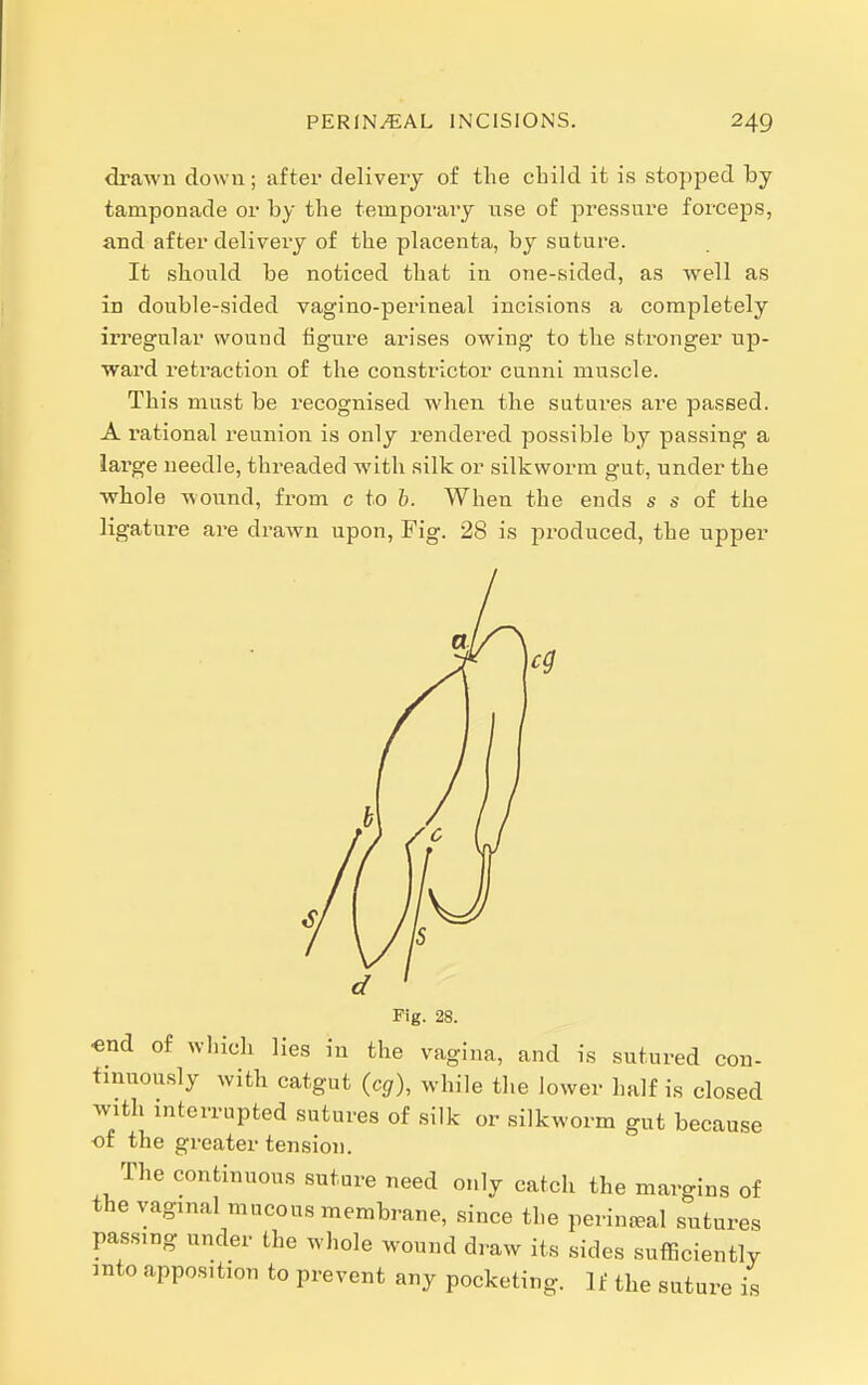 drawn down; after delivery of the child it is stopped by tamponade or by the tempoi-ary nse of pressure forceps, and after delivery of the placenta, by suture. It should be noticed that in one-sided, as vrell as in double-sided vagino-perineal incisions a completely irregular wound figure arises owing to the stronger up- ward retraction of the constrictor cunni muscle. This must be recognised when the sutures are passed. A rational reunion is only rendered possible by passing a large needle, threaded with silk or silkworm gut, under the whole wound, from c to b. When the ends s s of the ligature are drawn upon, Fig. 28 is produced, the upper Fig. 28. «nd of wliicli lies in the vagina, and is sutured con- tinuously with catgut (eg), while the lower half is closed with interrupted sutures of silk or silkworm gut because •of the greater tension. The continuous suture need only catch the margins of the vaginal mucous membrane, since the perinjeal sutures passing under the whole wound draw its sides sufSciently into apposition to prevent any pocketing. If the suture is