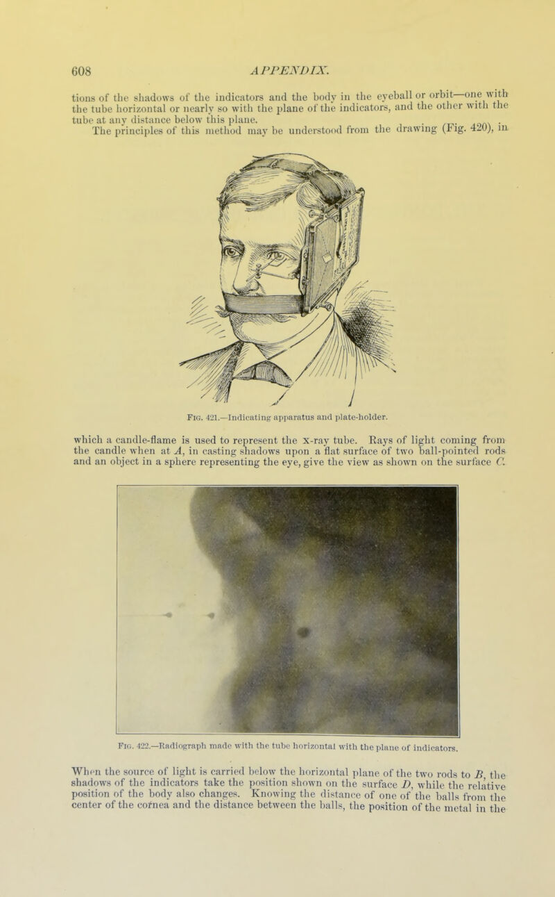 tions of the shadows of the indicators and the body in the eyeball or orbit—one wi the tube horizontal or nearly so with the plane of the indicators, and the other with tJ tube at any distance below this plane. . The principles of this method may be understood from the drawing (Fig. 420), Fig. 421.—Indicating apparatus and plate-holder. which a candle-flame is used to represent the x-ray tube. Rays of light coming from the candle when at A, in casting shadows upon a flat surface of two ball-pointed rods and an object in a sphere representing the eye, give the view as shown on the surface C. Fig. 422.—Radiograph made with the tube horizontal with the plane of indicators. When the source of light is carried below the horizontal plane of the two rods to B the shadows of the indicators take the position shown on the surface Z>, while the relative position of the body also changes. Knowing the distance of one of'the balls from the center of the cofnea and the distance between the balls, the position of the metal in the