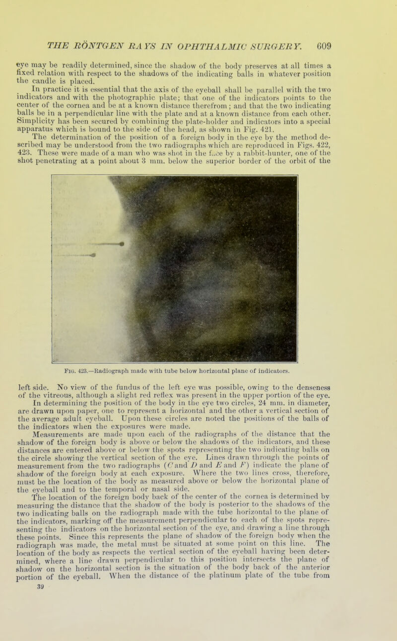 eye may be readily determined, since the shadow of the body preserve3 at all times a fixed relation with respect to the shadows of the indicating balls in whatever position the candle is placed. In practice it is essential that the axis of the eyeball shall be parallel with the two indicators and with the photographic plate; that one of the indicators points to the center of the cornea and be at a known distance therefrom; and that the two indicating balls be in a perpendicular line with the plate and at a known distance from each other. Simplicity has been secured by combining the plate-holder and indicators into a special apparatus which is bound to the side of the head, as shown in Fig. 421. The determination of the position of a foreign body in the eye by the method de- scribed may be understood from the two radiograplis which are reproduced in Figs. 422, 423. These were made of a man who was shot in the i.^ca by a rabbit-hunter, one of the shot penetrating at a point about 3 mm. below the superior border of the orbit of the Fig. 423.—Radiograph made with tube below horizontal plane of indicators. left side. No view of the fundus of the left eye was possible, owing to the denseness of the vitreous, although a slight red reflex was present in the upper portion of the eye. In determining the position of the body in the eye two circles, 24 mm. in diameter, are drawn upon paper, one to represent a liorizontal and the other a vertical section of the average adult eyeball. Upon these circles are noted the positions of the balls of the indicators when the exposures were made. Measurements are made upon each of the radiograplis of the distance that the shadow of the foreign body is above or below the shadows of the indicators, and these distances are entered above or below the spots representing tlie two indicating balls on the circle showing the vertical section of the eye. Lines drawn througii the points of measurement from the two radiographs (^7and/>and J? and F) indicate the plane of shadow of the foreign body at each exposure. Where the two lines cross, therefore, must be the location of the body as measured above or below the horizontal plane of the eyeball and to the temporal or nasal side. The location of the foreign body back of the center of the cornea is determined by measuring the distance that the shadow of the body is posterior to the shadows of the two indicating balls on the radiograpli made with the tube horizontal to the plane of the indicators, marking off the measurement perpendicular to each of the spots repre- senting the indicators on the horizontal section of the eye, ami drawing a line through these points. Since this represents the plane of shadow of the foreign body when the radiograph was made, the metal mnst be situated at some point on this line. The location of the body as respects the vertical section of the eyeball having been deter- mined where a line drawn ])erpendicular to this position intersects the plane of shadow on the horizontal section is the situation of the body back of the anterior portion of the eyeball. When the distance of the platinum plate of the tube from 39