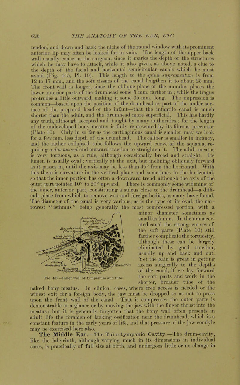 tendon, and down and back the niclie of the round window with its prominent anterior lip nuiy often be looked for in vain. The length of the upper back wall usually concerns the surgeon, since it marks the depth of the structures which he may have to attack, while it also gives, as above noted, a clue to the depth of the facial and horizontal semicircular canals which he must avoid (Fig. 445, PI. 10). This length to the spina suprameatum is from 12 to 17 mm., and the soft tissues of the canal lengthen it to about 25 mm. The front wall is longer, since the oblique plane of the annulus places the lower anterior parts of the drumhead some 5 nun. farther in ; while the tragus protrudes a little outward, making it some 35 nnii. long. The impression is common—based upon the position of the drumhead as part of the under sur- face of the prepared head of the infant—that the infantile canal is much shorter than the adult, and the drumhead more superficial. This has hardly any truth, although accepted and taught by many authorities; for the length of the undeveloped bony meatus is fully represented by its fibrous precursor (Plate 10). Only in so far as the cartilaginous canal is snialler may we look foi' a few mm. less depth of the driunhead. The caliber is smaller in infancy, and the rather collapsed tube follows the upward curve of the squama, re- quiring a downward and outward traction to straighten it. The adult meatus is very tortuous, as a rule, although occasionally broad and straight. Its lumen is usually oval; vertically at the exit, but inclining obliquely forward as it passes in, until the axis may be less than 45 from the horizontal. With this there is curvature in the vertical ])lane and sometimes in the horizontal, so that the inner portion has often a downward trend, although the axis of the outer part pointed 10° to 20° upward. There is connnonly some widening of the inner, anterior part, constituting a sulcus close to the drumhead—a diffi- cult place from which to remove wax and foreign bodies, as many have found. The diameter of the canal is very various, as is the type of its oval, the nar- rowest  isthmus being generally the most compressed portion, with a minor diameter sometimes as small as 5 mm. In the unmacer- ated canal the strong curves of the soft parts (Plate 10) still farther complicate the tortuosity, although these can be largely eliminated by good traction, usually up and back and out. Yet the gain is great in getting access surgically to the depths of the canal, if Ave lay forward the soft parts and work in the shorter, broader tube of the naked bony meatus. In clinical cases, where free access is needed or the widest exit for a foreign body, the jaw must be dropped so as not to press upon the front wall of the canal. That it compresses the outer parts is demonstrable at a glance or by moving the jaw with the finger thrust into the meatus; but it is generally forgotten that the bony wall often jiresents in adult life the foramen of lacking ossification near the drumhead, which is a constant feature in the early years of life, and that pressure of the jaw-condyle may be exercised here also. The Middle Bar.—The Tubo-tympanic Cavity.—The drum-cavity, like the labyrinth, although varying much in its dimensions in individual cases, is practically of full size at birth, and undergoes little or no change in Fig. 445.—Inner wall of tympanum and tube.