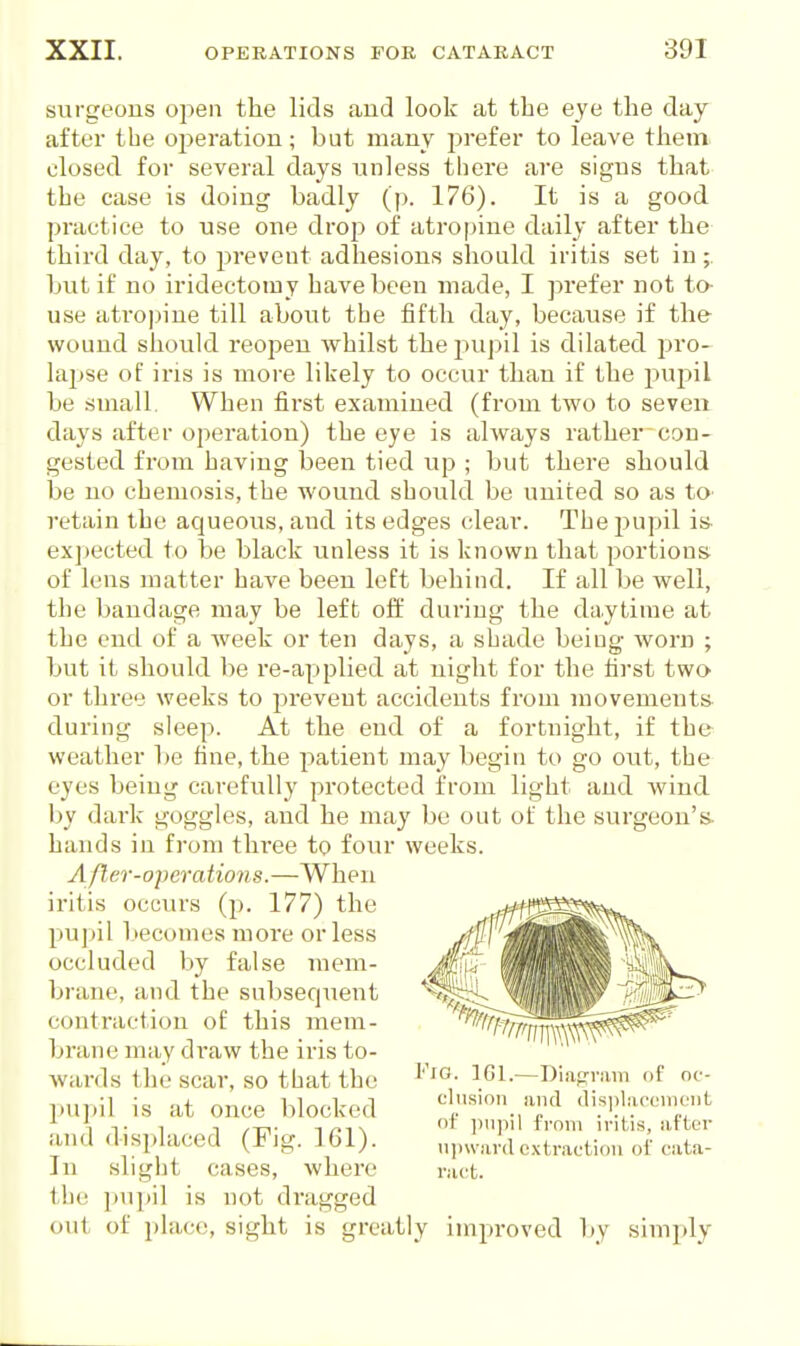 surgeons open the lids and look at the eye the day after the ojjeration; but many jirefei* to leave them, closed for several days unless there are signs that the case is doing badly (p. 176). It is a good practice to use one drop of atropine daily after the third day, to prevent adhesions should iritis set in • but if no iridectomy have been made, I prefer not to- use ati'opine till about the fifth day, because if the- wound should reopen whilst the pupil is dilated pro- lajjse of iris is more likely to occur than if the pujsil be small. When first examined (from two to seven days after operation) the eye is always rather con- gested from having been tied up ; but there should be no chemosis, the wound should be united so as to- retain the aqueous, and its edges clear. The pupil i» expected to be black unless it is known that portions: of lens matter have been left behind. If all be well, the bandage may be left off during the da.ytime at the end of a Aveek or ten days, a shade being worn ; but it should be re-applied at night for the first two or three weeks to j^revent accidents from niovements during sleep. At the end of a fortnight, if the weather be fine, the patient may begin to go out, the eyes being carefully protected from light and wind by dark goggles, and he may be out of the surgeon's, hands in from thi'ee to fonv weeks. A/ler-operations.—When iritis occurs (p. 177) the pupil becomes more or less occluded by false mem- brane, and the subsecpient contraction of this mem- brane may draw the iris to- Avards the scar, so that the pupil is at once blocked and displaced (Fig. 161). In slight cases, where the pupil is not dragged out of place, sight is greatly improved by simply FiO. IGl.—Diap-riim of oc- clusion iiiid disijliiccinciit of ])iipil from iritis, after ii])\vai'(l cvtractiou oi cata- r.-ict.