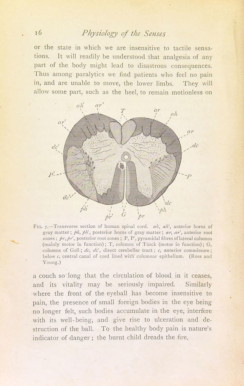 or the state in which we are insensitive to tactile sensa- tions. It will readily be understood that analgesia of any part of the body might lead to disastrous consequences. Thus among paralytics we find patients who feel no pain in, and are unable to move, the lower limbs. They will allow some part, such as the heel, to remain motionless on Fig. 7.—Transverse section of human spinal cord, a/i, ah', anterior horns of gray matter; fih', posterior horns of gray matter ; ar, ar1, anterior root zones; j>r,j>r, posterior root zones ; P, P', pyramidal fibres of lateral columns (mainly motor in function); T, columns of Tiirck (motor in function); G, columns of Goll; dc, dc', direct cerebellar tract; c, anterior commissure ; below c, central canal of cord lined with' columnar epithelium. (Ross and Young.) a couch so'long that the circulation of blood in it ceases, and its vitality may be seriously impaired. Similarly where the front of the eyeball has become insensitive to pain, the presence of small foreign bodies in the eye being no longer felt, such bodies accumulate in the eye, interfere with its well-being, and give rise to ulceration and de- struction of the ball. To the healthy body pain is nature's indicator of danger ; the burnt child dreads the fire.