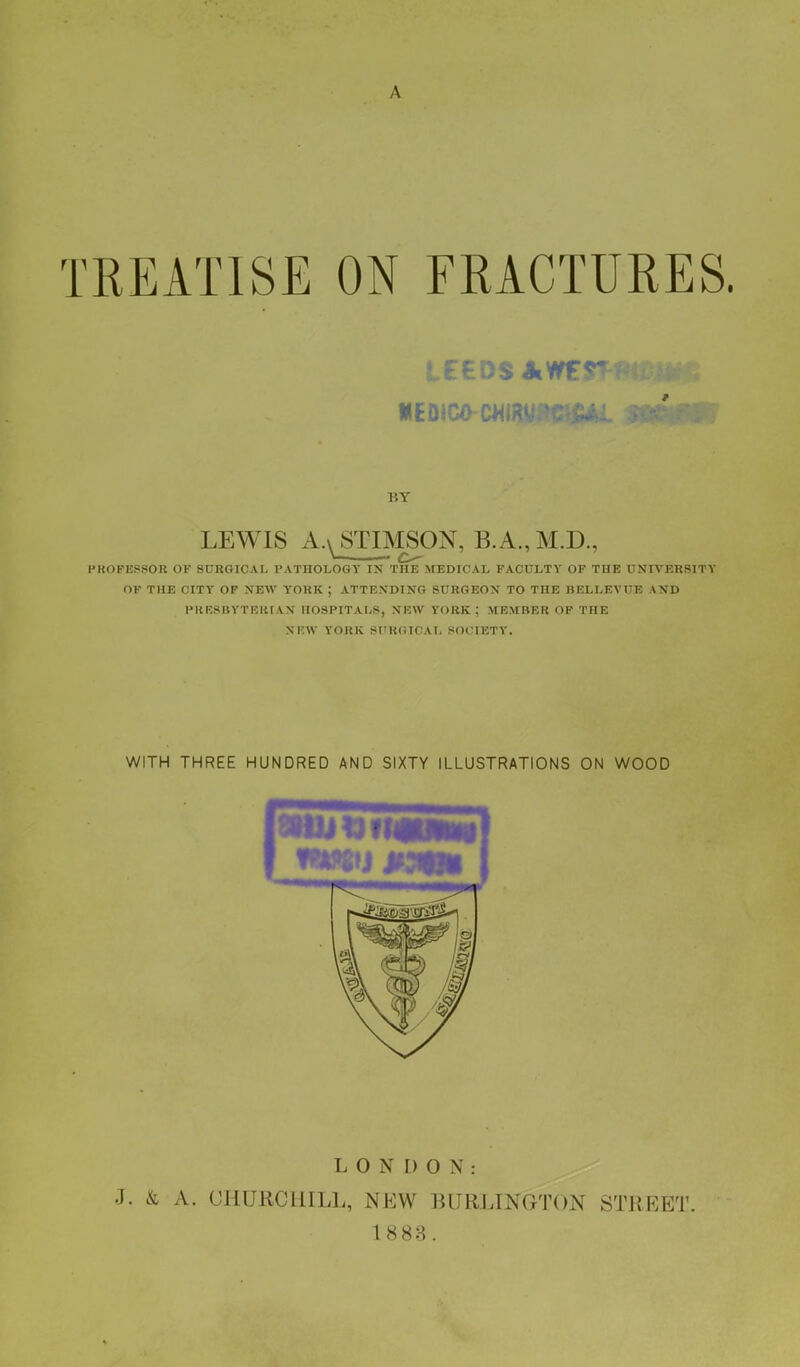 A TREATISE ON FRACTURES. BY LEWIS AASTIMSON, B.A.,M-L^ \ o- PKOFESSOR OK SURGICAL PATHOLOGY IN THE MEDICAL FACULTY OF THE UNIVERSITY OF THE CITY OF NEW Y'ORK ; ATTENDING SURGEON TO THE BELLEVUE AND PRBSBYTHRIAJK HOSPITALS, NEW YORK; MEMBER OF THE Nl'.W YORK SI'KGICAL SOCIETY. LONDON: ■I. & A. CHURCH ILL, NKW burlhstgton street. 1883.