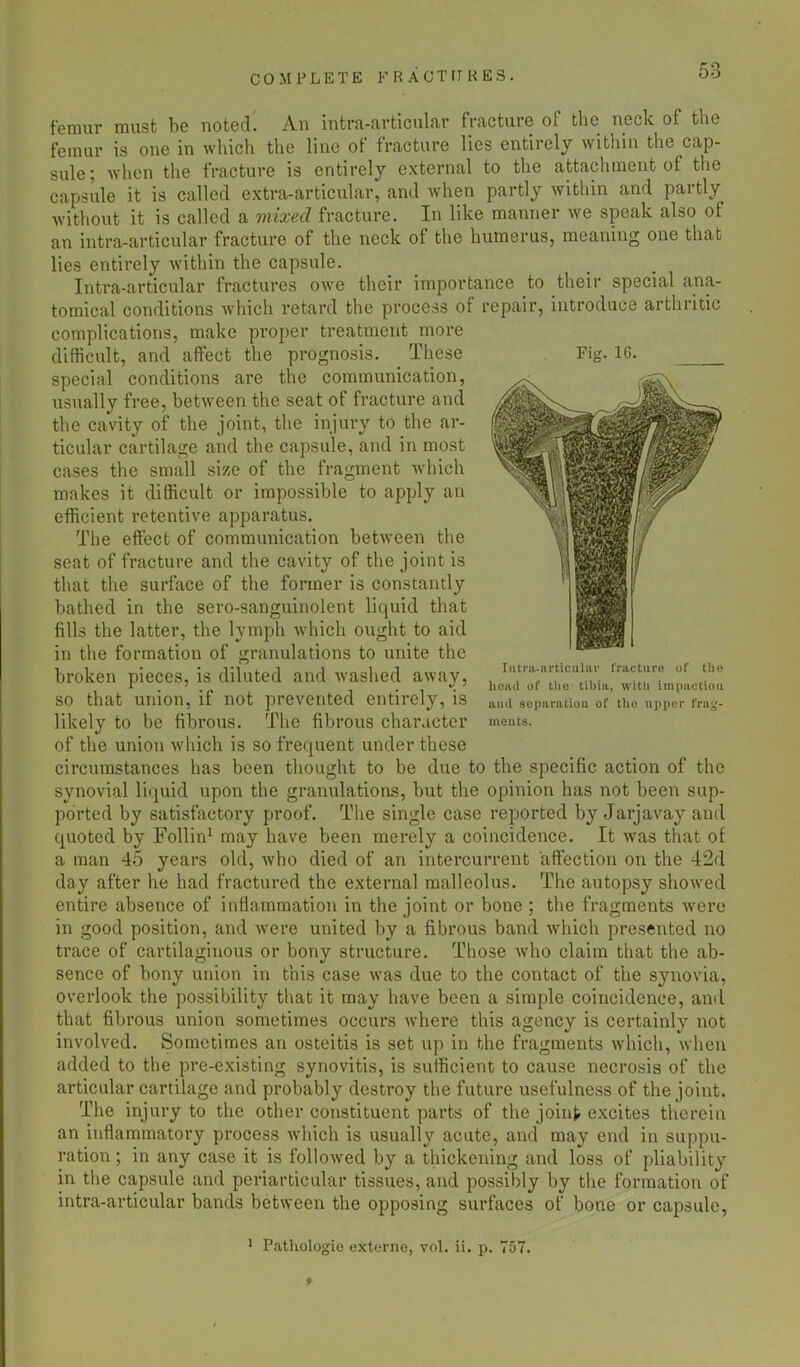 Fig. 16. femur must be noted! An intra-articular fracture of the neck of the femur is one in which the line of fracture lies entirely within the cap- sule ; when the fracture is entirely external to the attachment of the capsule it is called extra-articular, and when partly within and partly without it is called a mixed fracture. In like manner we speak also of an intra-articular fracture of the neck of the humerus, meaning one that lies entirely within the capsule. Intra-articular fractures owe their importance to their special ana- tomical conditions which retard the process of repair, introduce arthritic complications, make proper treatment more difficult, and aflFect the prognosis. These special conditions are the communication, usually free, between the seat of fracture and the cavity of the joint, the injury to the ar- ticular cartilage and the capsule, and in most cases the small size of the fragment which makes it difficult or impossible to apply an efficient retentive apparatus. The effect of communication between the seat of fracture and the cavity of the joint is that the surface of the former is constantly bathed in the sero-sanguinolent liquid that fills the latter, the lymph which ought to aid in the formation of granulations to unite the broken pieces, is diluted and washed away, so that union, if not prevented entirely, is likely to be fibrous. The fibrous character of the union which is so frequent under these circumstances has been thought to be due to the specific action of the synovial liquid upon the granulations, but the opinion has not been sup- ported by satisfactory proof. The single case reported by Jarjavay and quoted by Follin1 may have been merely a coincidence. It was that of a man 45 years old, who died of an intercurrent affection on the 42d day after he had fractured the external malleolus. The autopsy showed entire absence of inflammation in the joint or bone ; the fragments were in good position, and were united by a fibrous band which presented no trace of cartilaginous or bony structure. Those who claim that the ab- sence of bony union in this case was due to the contact of the synovia, overlook the possibility that it may have been a simple coincidence, and that fibrous union sometimes occurs where this agency is certainly not involved. Sometimes an osteitis is set up in the fragments which, when added to the pre-existing synovitis, is sufficient to cause necrosis of the articular cartilage and probably destroy the future usefulness of the joint. The injury to the other constituent parts of the joint excites therein an inflammatory process which is usually acute, and may end in suppu- ration ; in any case it is followed by a thickening and loss of pliability in the capsule and periarticular tissues, and possibly by the formation of intra-articular bands between the opposing surfaces of bone or capsule, Intra-articular fracture of the head of the tihia, with irapactiou and separation of the upper frag- ments. 1 Pathologie externe, vol. ii. p. 757.