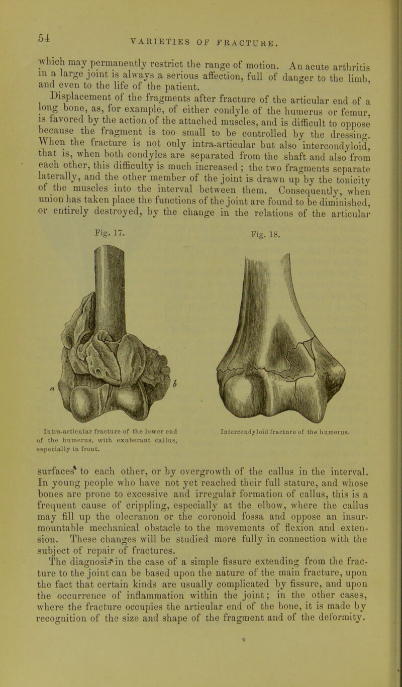 VARIETIES OF FRACTUK E• which may permanently restrict the range of motion. An acute arthritis m a large joint is always a serious affection, full of danger to the limb and even to the life of the patient. Displacement of the fragments after fracture of the articular end of a long bone, as, for example, of either condyle of the humerus or femur is favored by the action of the attached muscles, and is difficult to oppose because the fragment is too small to be controlled by the dressing. When the fracture is not only intra-articular but also intercondyloid, that is, when both condyles are separated from the shaft and also from each other, this difficulty is much increased ; the two fragments separate laterally, and the other member of the joint is drawn up by the tonicity of the muscles into the interval between them. Consequently, when union has taken place the functions of the joint are found to be diminished, or entirely destroyed, by the change in the relations of the articular Fig. n. Fi<*. 18. Intra-articular fracture of the lower end of the humerus, with exuberant callus, especially iu front. Intercondyloid fracture of the humerus. surfaces* to each other, or by overgrowth of the callus in the interval. In young people who have not yet reached their full stature, and whose bones are prone to excessive and irregular formation of callus, this is a frequent cause of crippling, especially at the elbow, where the callus may fill up the olecranon or the coronoid fossa and oppose an insur- mountable mechanical obstacle to the movements of flexion and exten- sion. These changes will be studied more fully in connection with the subject of repair of fractures. The diagnosis in the case of a simple fissure extending from the frac- ture to the joint can be based upon the nature of the main fracture, upon the fact that certain kinds are usually complicated by fissure, and upon the occurrence of inflammation within the joint; in the other cases, where the fracture occupies the articular end of the bone, it is made by recognition of the size and shape of the fragment and of the deformity.