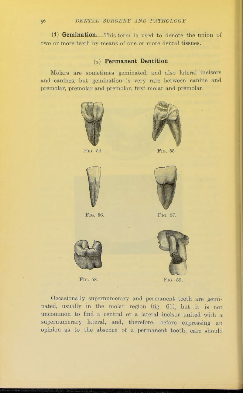 (1) Gemination—This term is used to denote the union of t^wo or more teeth hy means of one or more dental tissues. (a) Permanent Dentition Molars are sometimes geminated, and also lateral incisors and canines, but gemination is very rare between canine and premolar, premolar and premolar, first molar and premolar. Fig. 58. Fig. 59. Occasionally supernumerary and permanent teeth are gemi- nated, usually in the molar region (fig. 61), but it is not uncommon to find a central or a lateral incisor united with a supernumerary lateral, and, therefore, before expressing an opinion as to the absence of a permanent tooth, care should