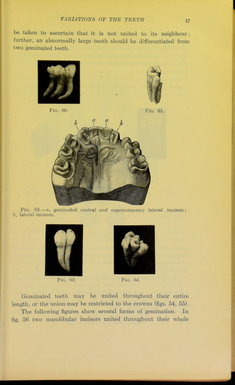 be taken to ascertain that it is not united to its neighbour; further, an abnormally large tooth should be differentiated from two geminated teeth. Fig. 62. — a, gemiuated central and supernumerary lateral incisors; b, lateral incisors. Fig. 63. Fig. 64. Geminated teeth may be united throughout their entire length, or the union may be restricted to the crowns (figs. 54, 55). The following figures show several forms of gemination. In fig. 56 two mandibular incisors united throughout their whole