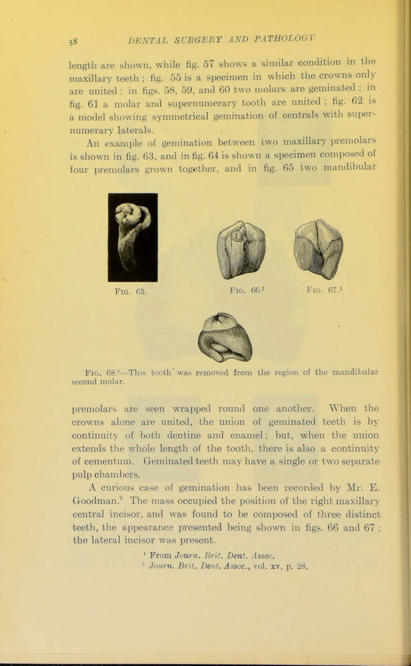 lengtli are shown, while fig. 57 shows a similar condition in the maxillary teeth ; fig. 55 is a specimen in which the crowns only are united ; in figs. 58, 59, and 60 two molars are geminated ; in fig. 61 a molar and supernumerary tooth are united ; fig. 62 is a model showing symmetrical gemmation of centrals with super- numerary laterals. An example of gemination between two maxillary premolars is shown in fig. 63, and in fig. 64 is shown a specimen composed of four premolars grown together, and in fig. 65 two mandibular Fig. 65. Fig. 6G.1 Fig. 67.1 Fig. 68.'—This tooth'was removed from the region of the mandibular second molar. premolars are seen wrapped round one another. When the crowns alone are united, the union of geminated teeth is by continuity of both dentine and enamel; but, when the union extends the whole length of the tooth, there is also a continuity of cementum. Geminated teeth may have a single or two separate pulp chambers. A curious case of gemination has been recorded by Mr. E. Goodman.'2 The mass occupied the position of the right maxillary central incisor, and was found to be composed of three distinct teeth, the appearance presented being shown in figs. 66 and 67 ; the lateral incisor was present. 1 From Jouni. Brit. Dent. Assoc. ■ Joum. Brit. Dent. Assoc., vol. xv, p. 28.