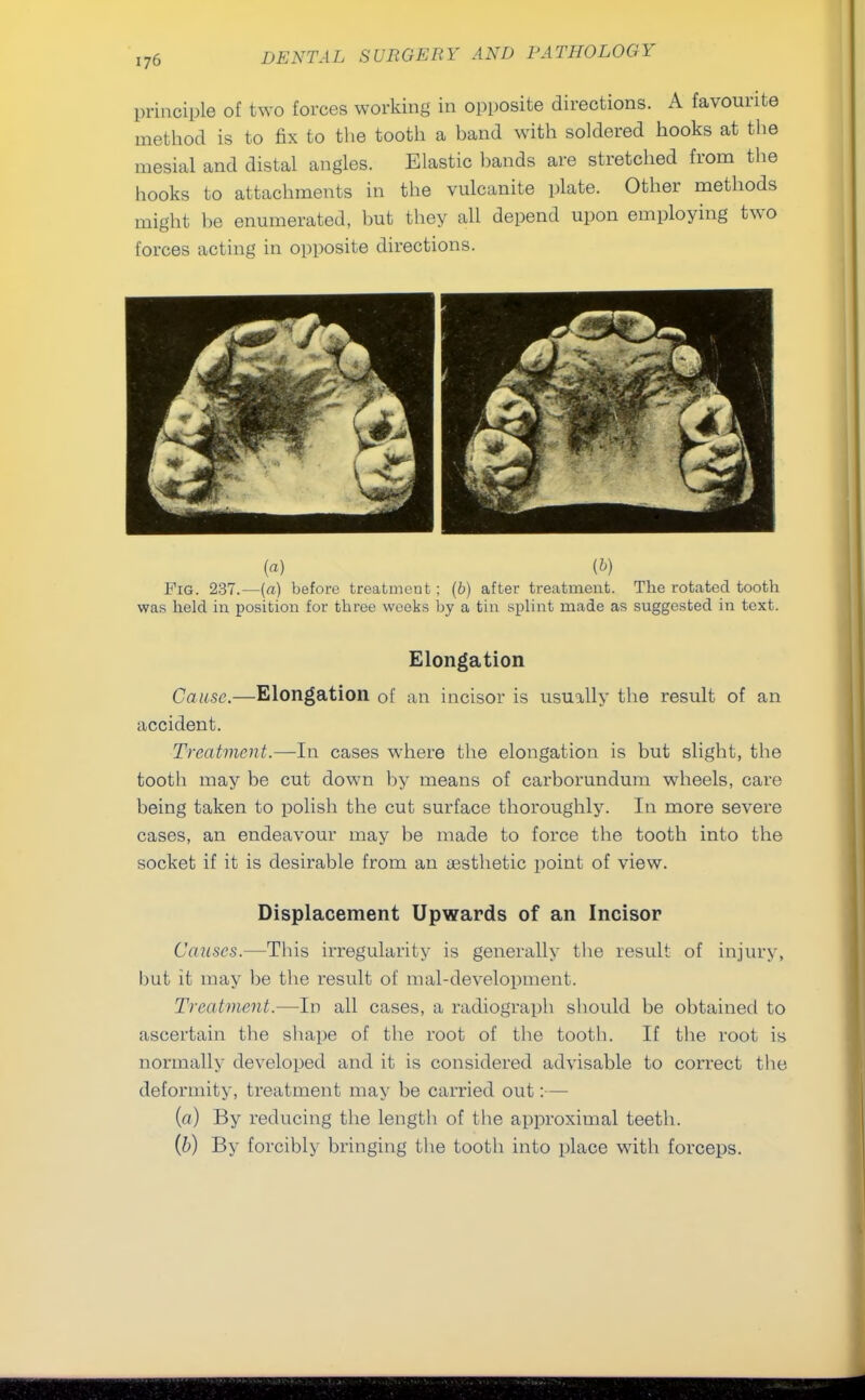 principle of two forces working in opposite directions. A favourite method is to fix to the tooth a hand with soldered hooks at the mesial and distal angles. Elastic hands are stretched from the hooks to attachments in the vulcanite plate. Other methods might be enumerated, hut they all depend upon employing two forces acting in opposite directions. (a) (b) Fig. 237.—(a) before treatment; (b) after treatment. The rotated tooth was held in position for three weeks by a tin splint made as suggested in text. Elongation Cause.—Elongation of an incisor is usually the result of an accident. Treatment.—In cases where the elongation is but slight, the tooth may be cut down by means of carborundum wheels, care being taken to polish the cut surface thoroughly. In more severe cases, an endeavour may be made to force the tooth into the socket if it is desirable from an assthetic point of view. Displacement Upwards of an Incisor Causes.—This irregularity is generally the result of injury, but it may be the result of mal-development. Treatment.—In all cases, a radiograph should be obtained to ascertain the shape of the root of the tooth. If the root is normally developed and it is considered advisable to correct the deformity, treatment may be carried out:— (a) By reducing the length of the approximal teeth. (b) By forcibly bringing the tooth into place with forceps.