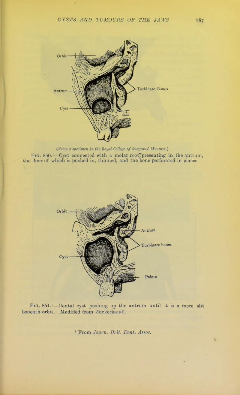 (From a specimen in the Royal College of Surgeons' Museum.) Fig. 850.'—Cyst connected with a molar roo ^presenting in the antrum, the floor of which is pushed in, thinned, and the bone perforated in places. Antrum Turbinate bones Palate Fig. 851.'—Dental cyst pushing up the antrum until it is a mere slit beneath orbit. Modified from Zuckerkandl. 1 From Journ. Brit. Dent. Assoc.